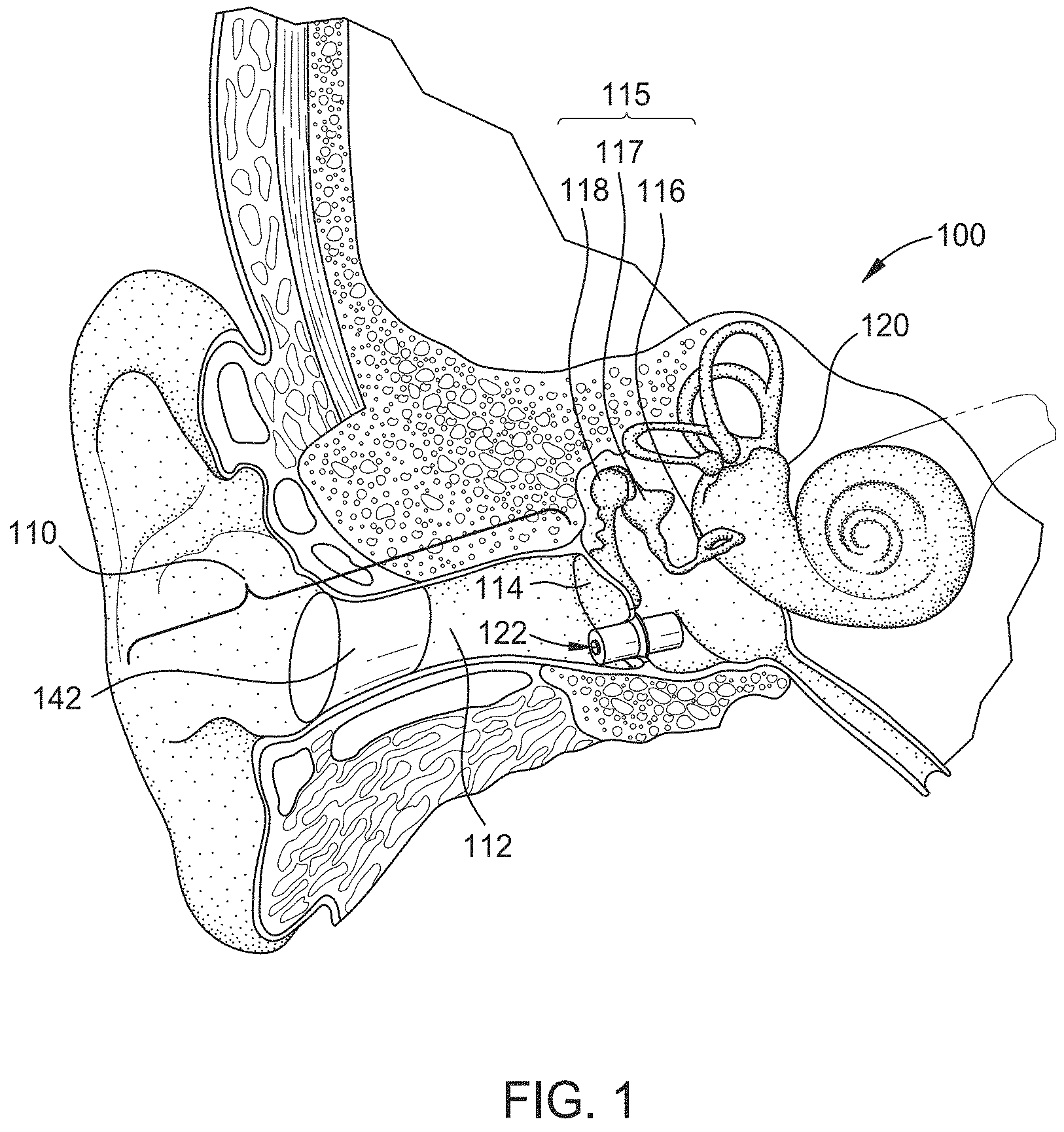 Patent US11785401 — Hearing aid implant recharging system — Figure 1