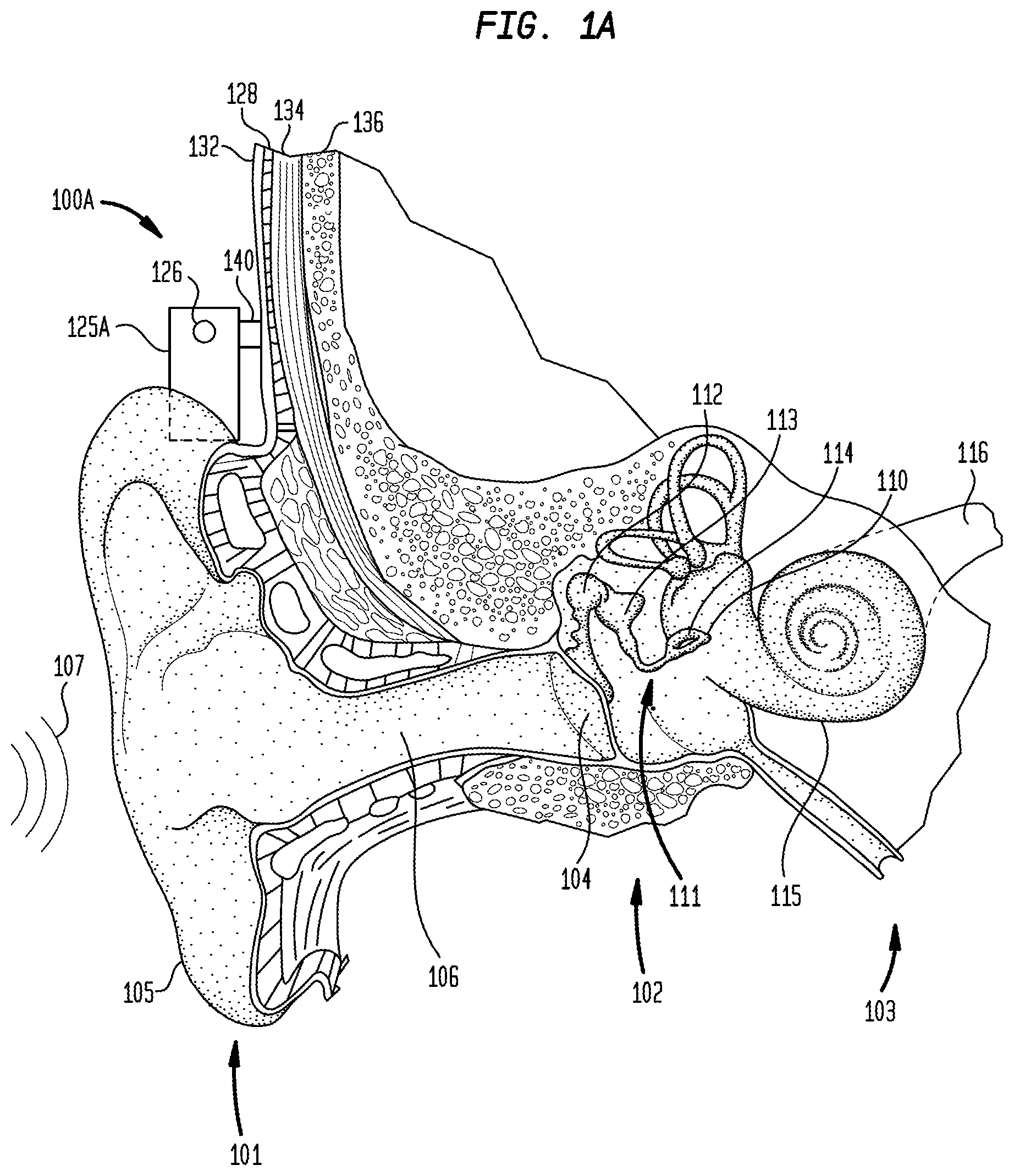 Patent US11785402 Figure 1 – Environmental classification controlled output level in bone conduction devices