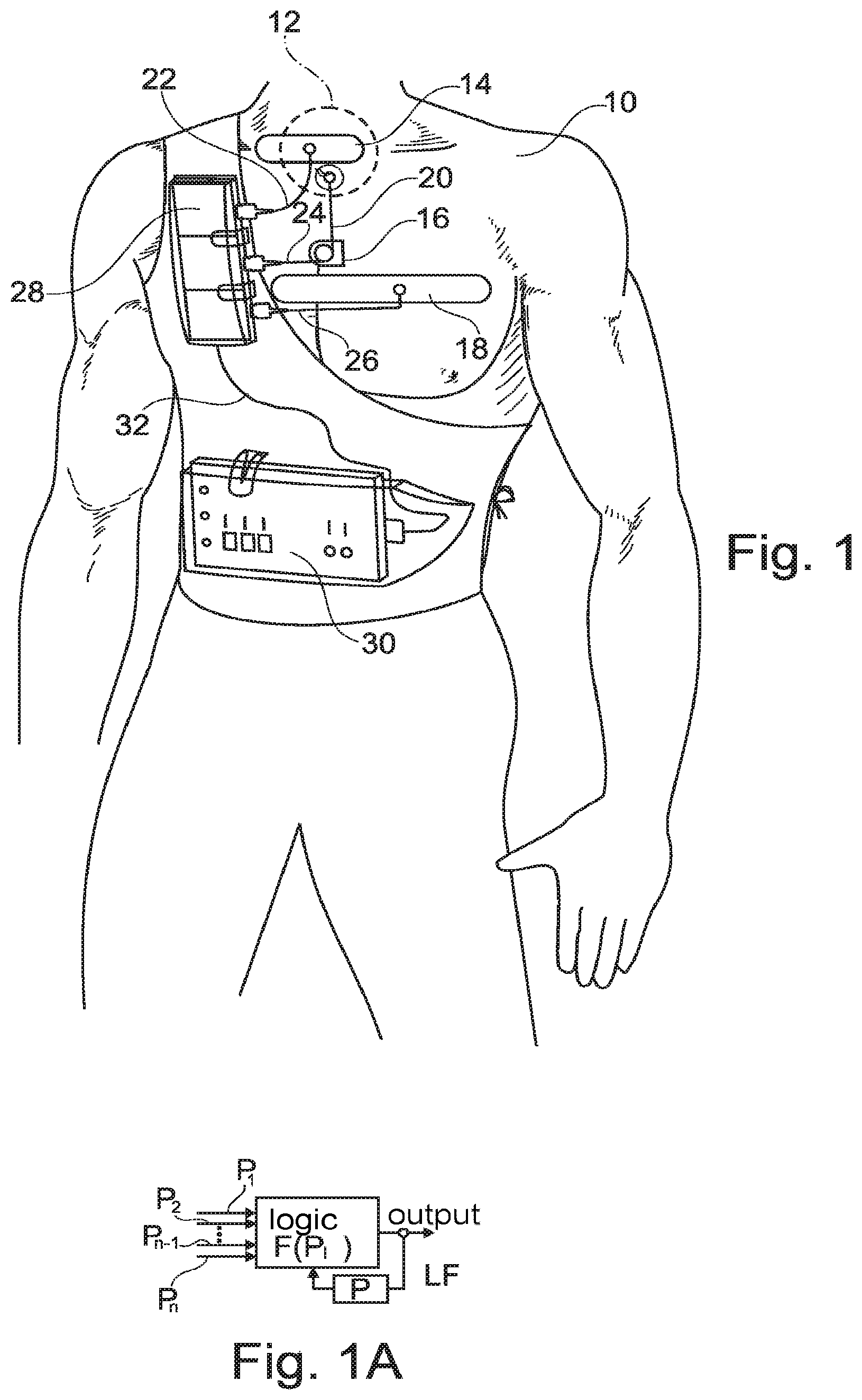 Patent US11793409 — System for the early detection of postoperative bleeding — Figure 1