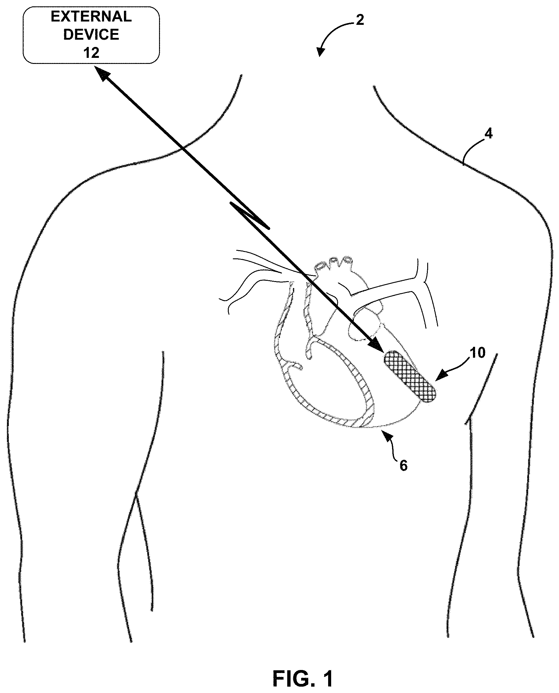 Patent US11793411 Figure 1 – Sensing for heart failure management