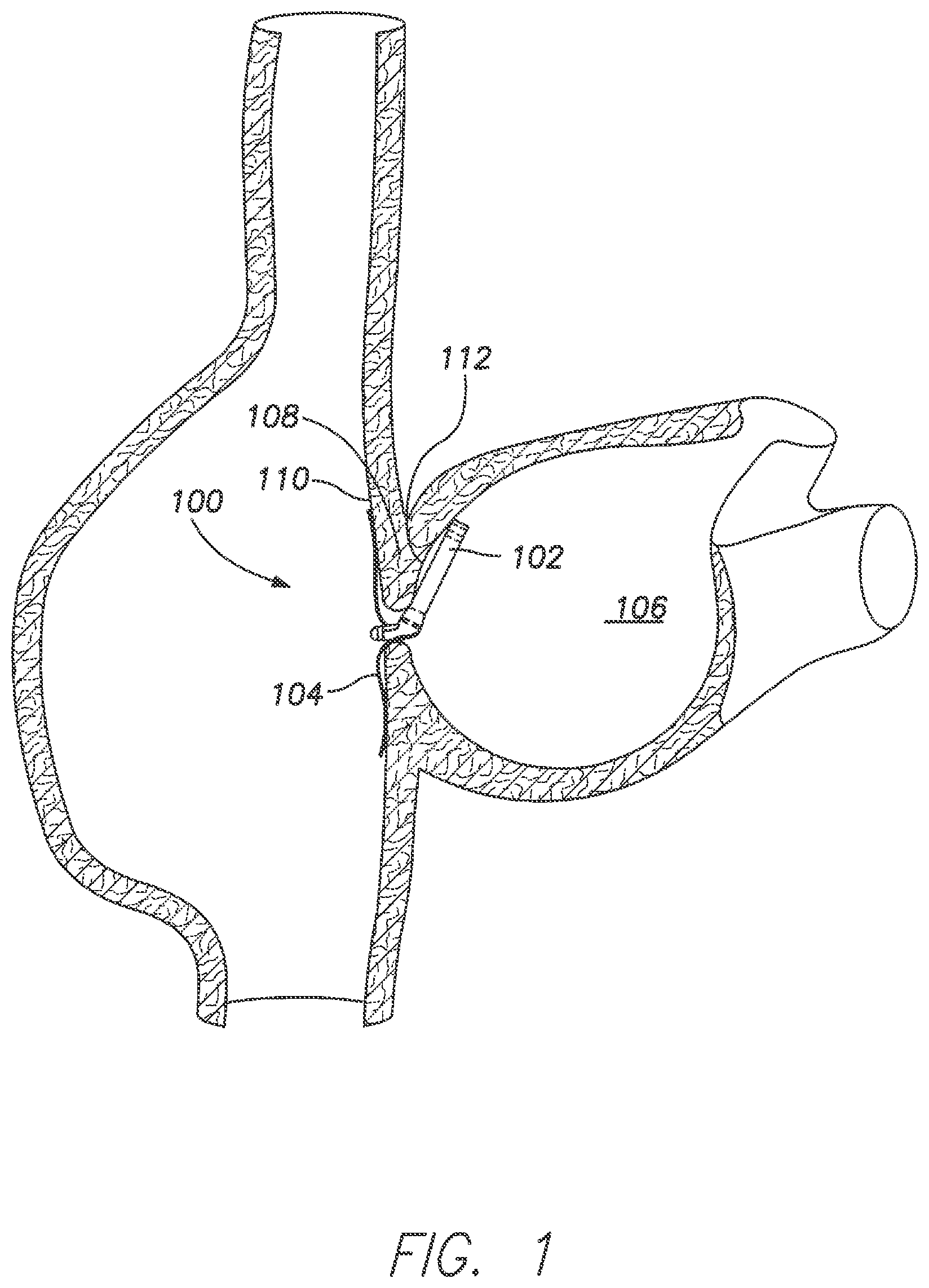 Patent US11793413 — Wireless MEMS left atrial pressure sensor — Figure 1