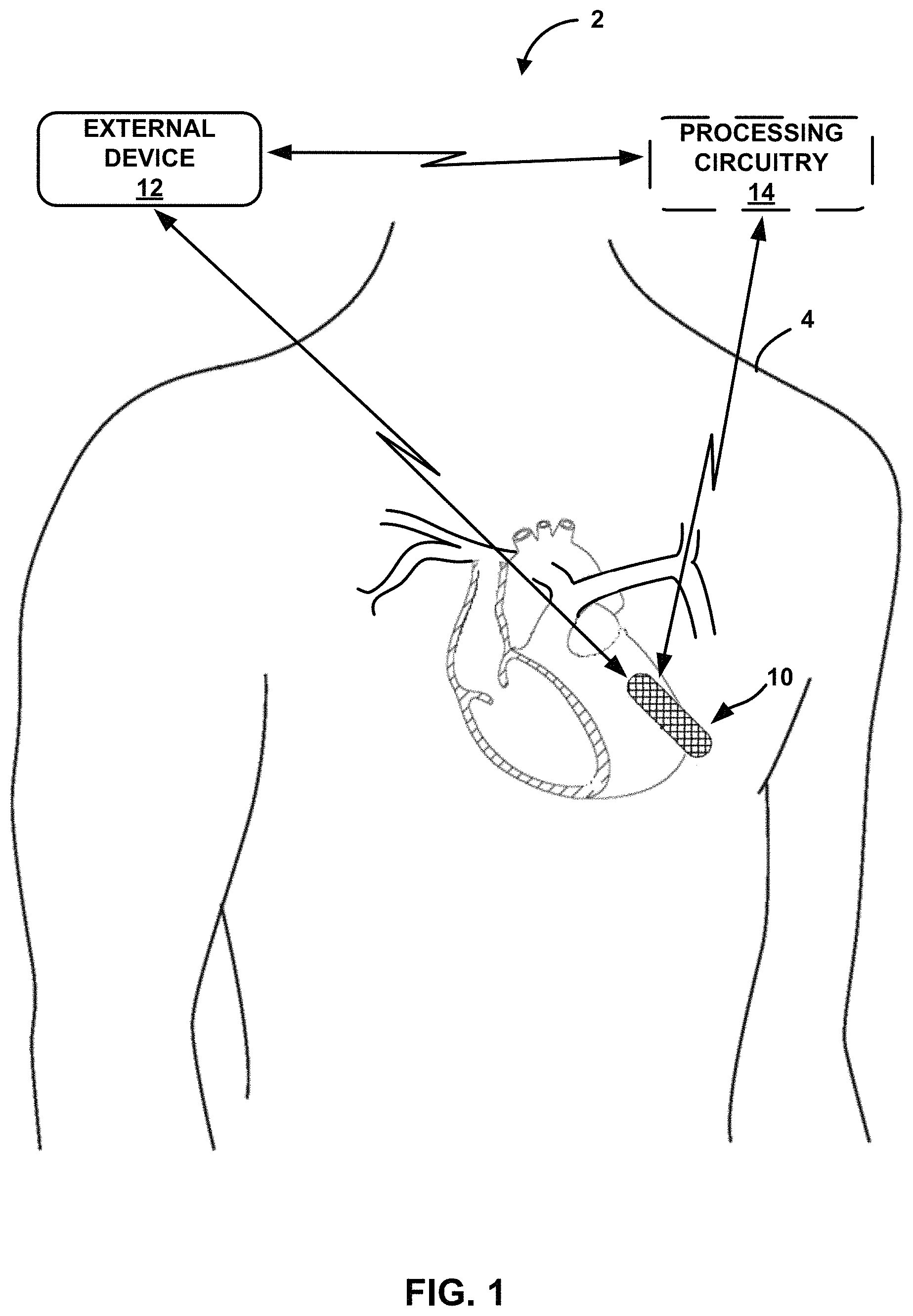 Patent US11793423 — Cough detection using frontal accelerometer — Figure 1