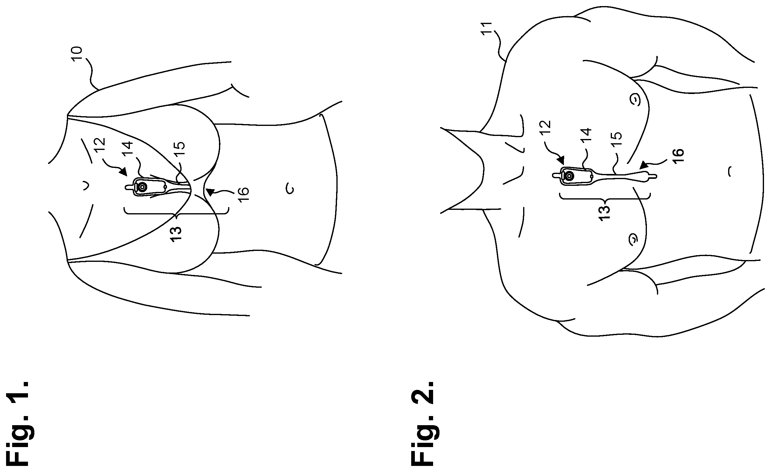 Patent US11793441 Figure 1 – Electrocardiography patch