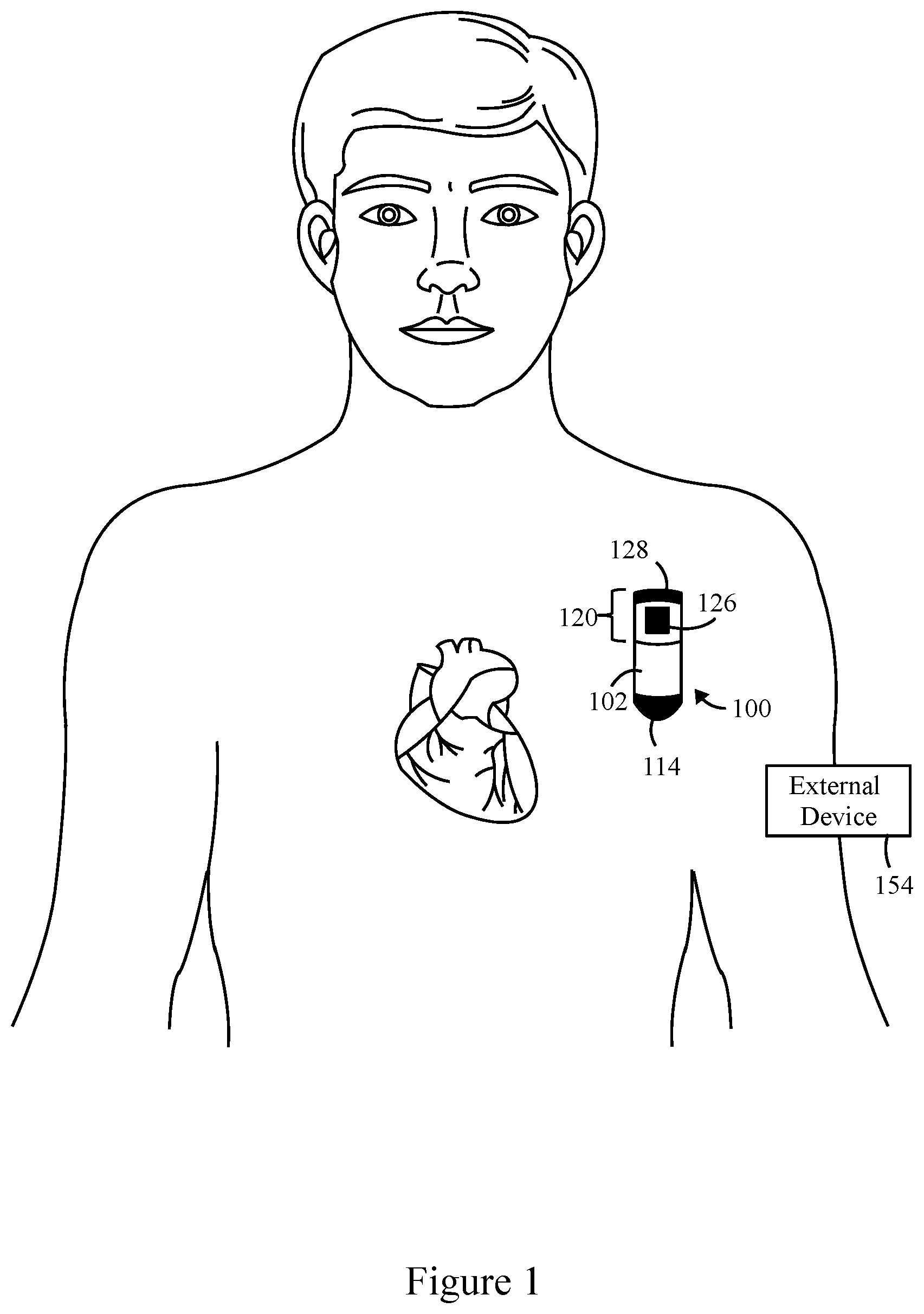 Patent US11793445 — Method and system to detect P-waves in cardiac arrhythmic patterns — Figure 1