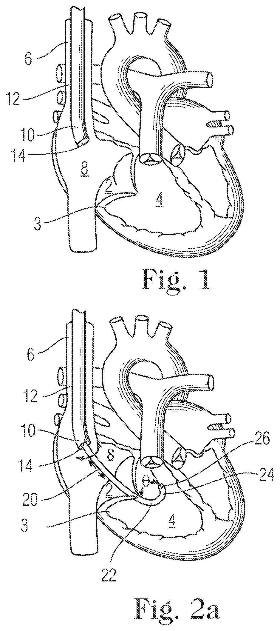 Patent US11793505 — Devices and methods for percutaneous tricuspid valve repair — Figure 1