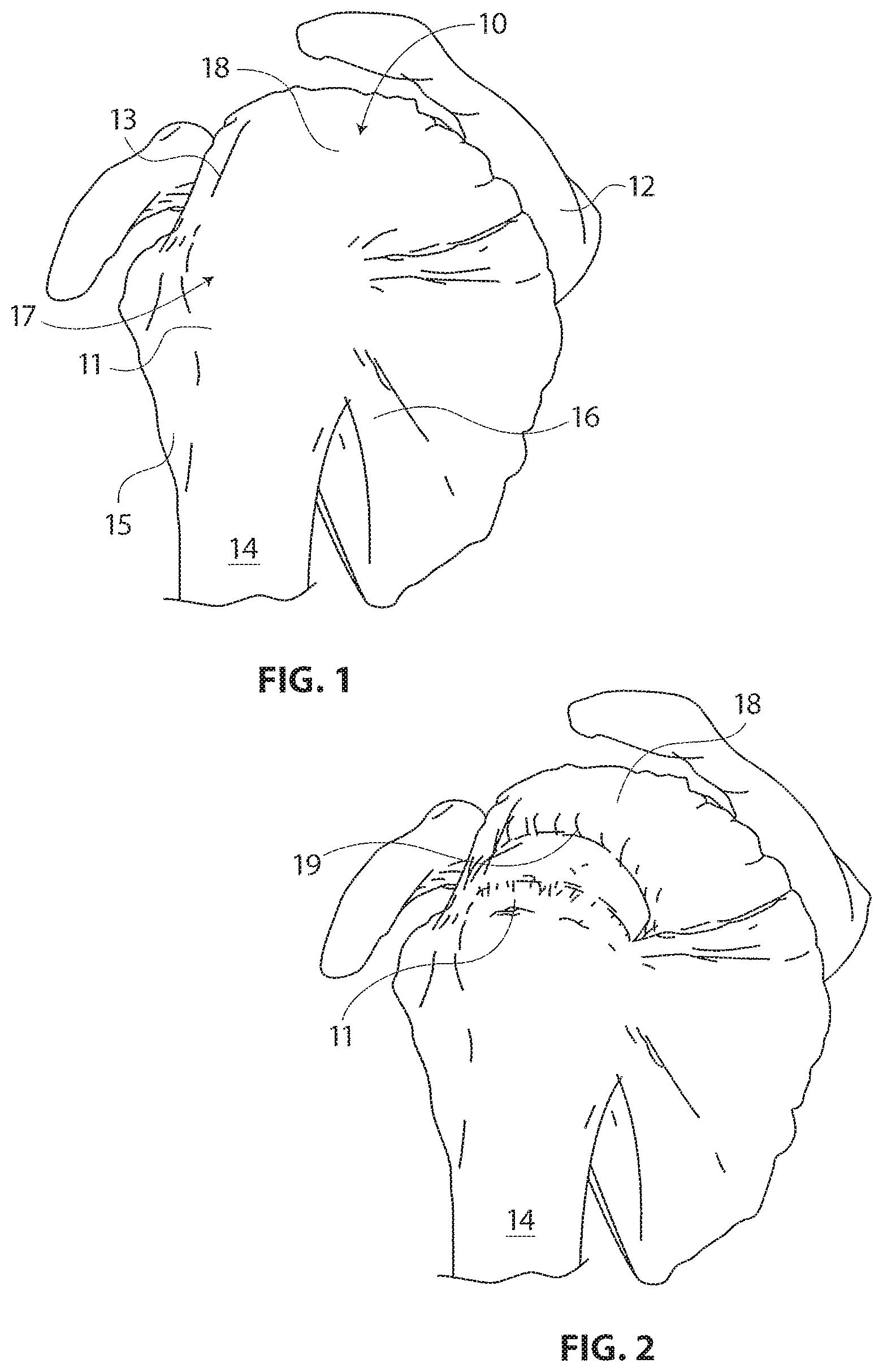 Patent US11793510 — Methods and apparatus for delivering staples to a target tissue — Figure 1