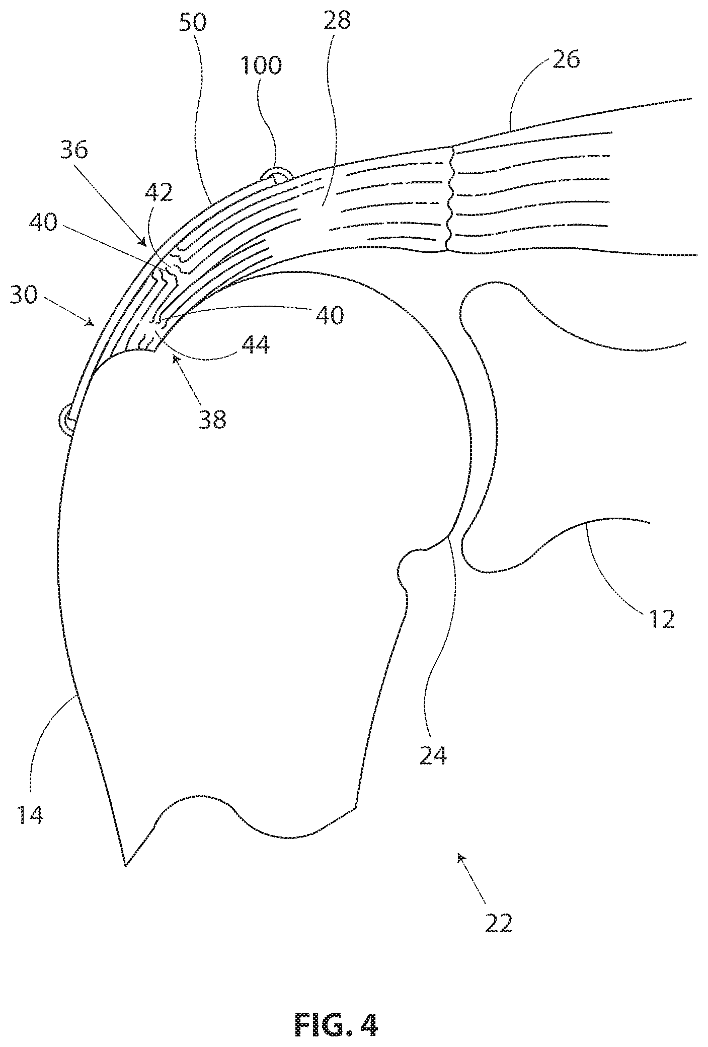 Patent US11793510 Figure 3 – Methods and apparatus for delivering staples to a target tissue