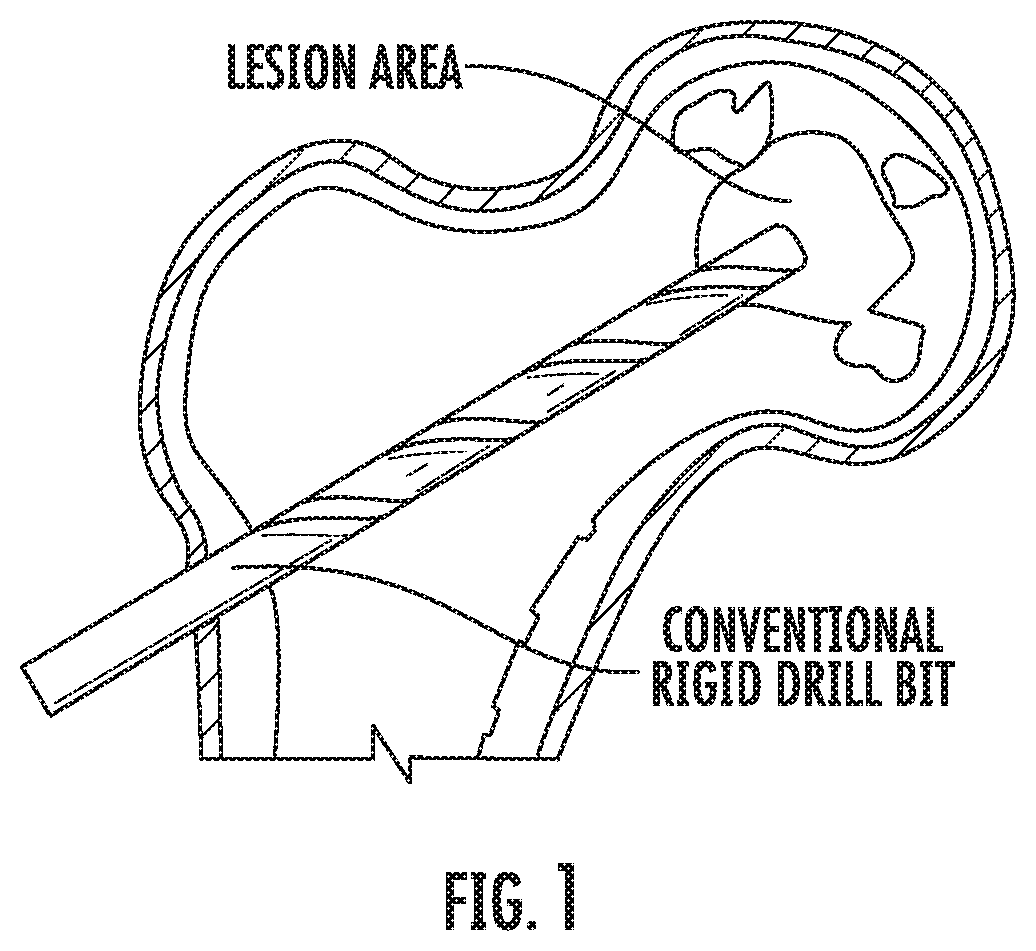 Patent US11793526 — Steerable drill for minimally-invasive surgery — Figure 1
