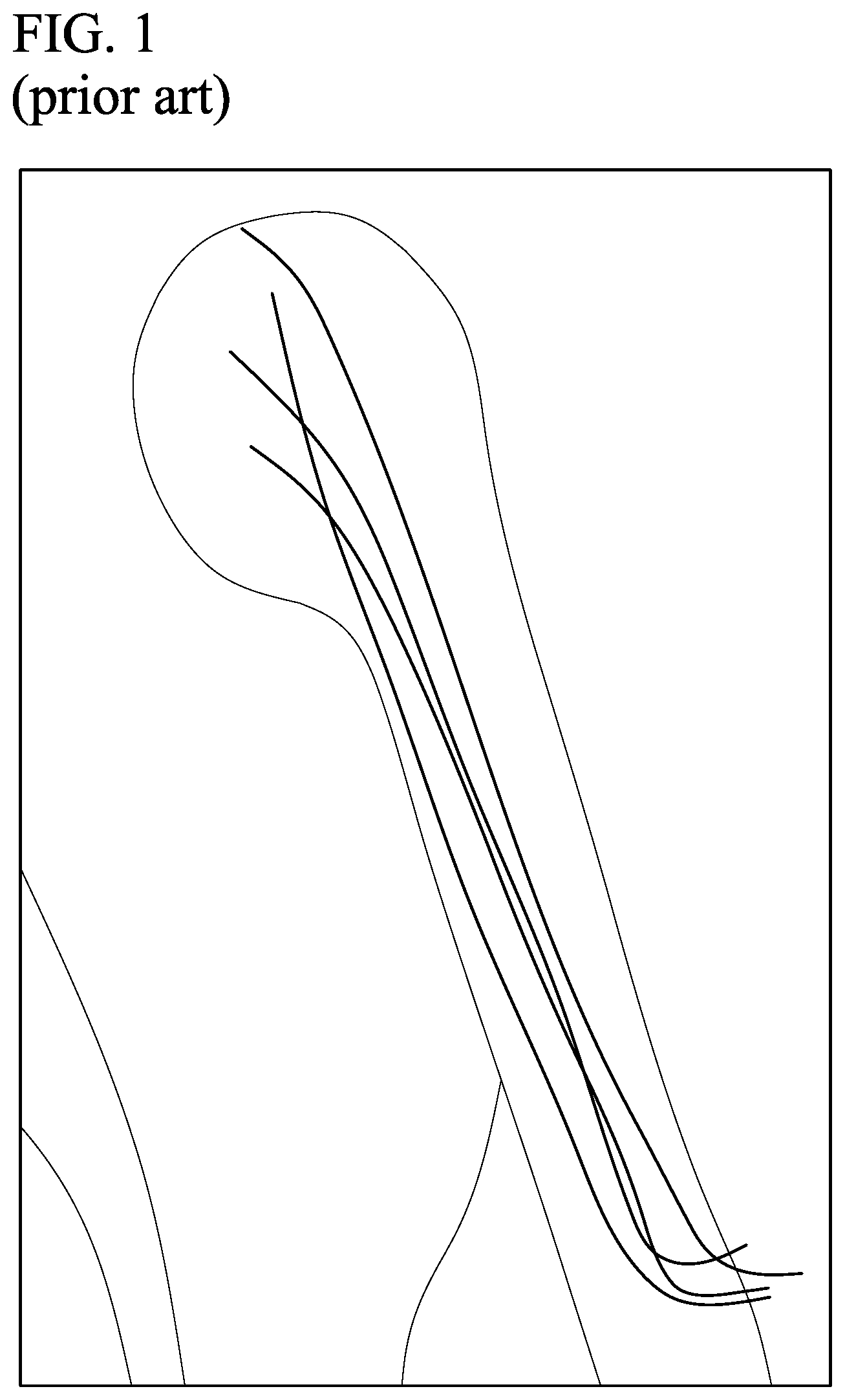 Patent US11793528 — Supracondylar fracture mending device — Figure 1