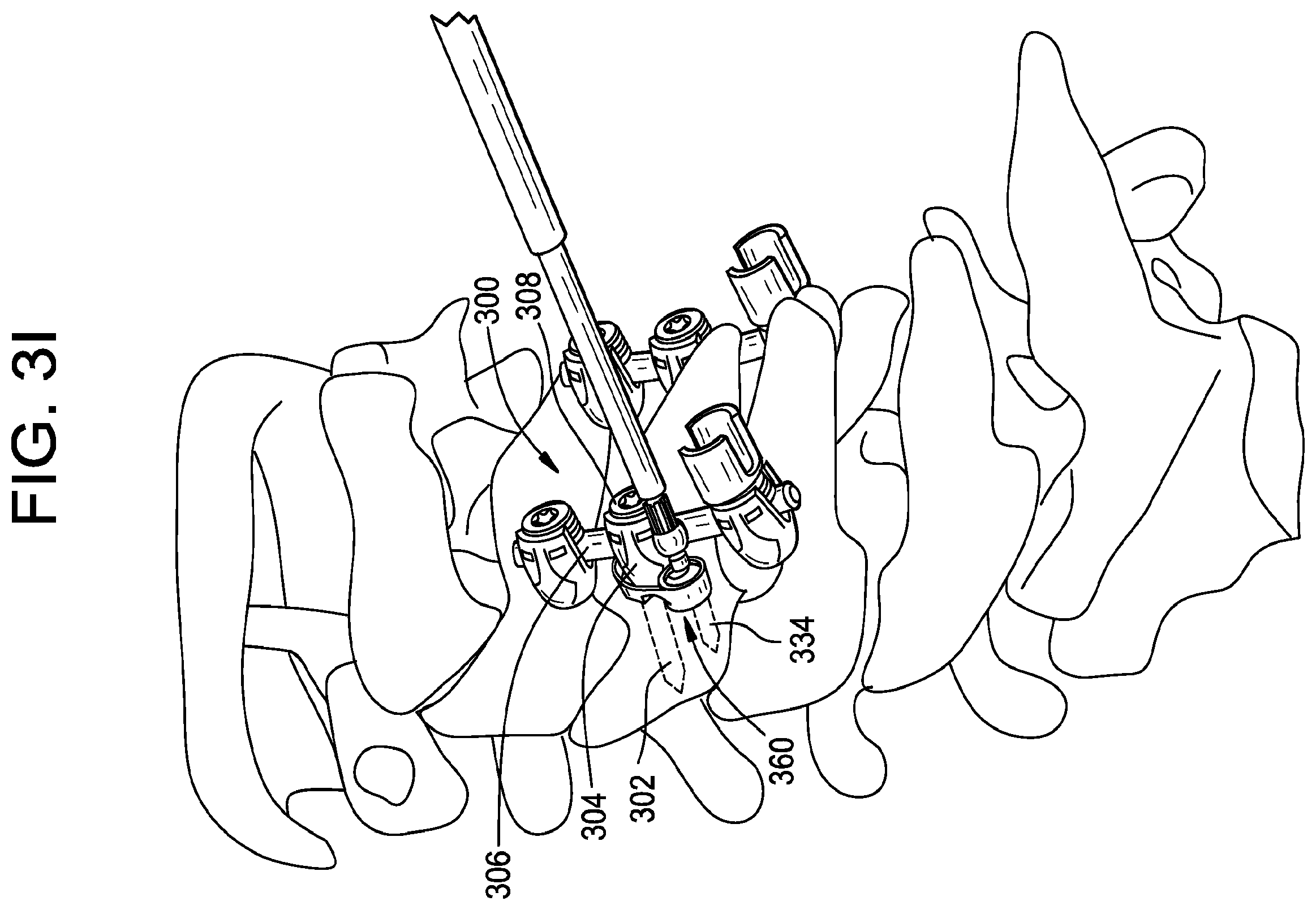 Patent US11793551 Figure 10 – Multipoint fixation implants