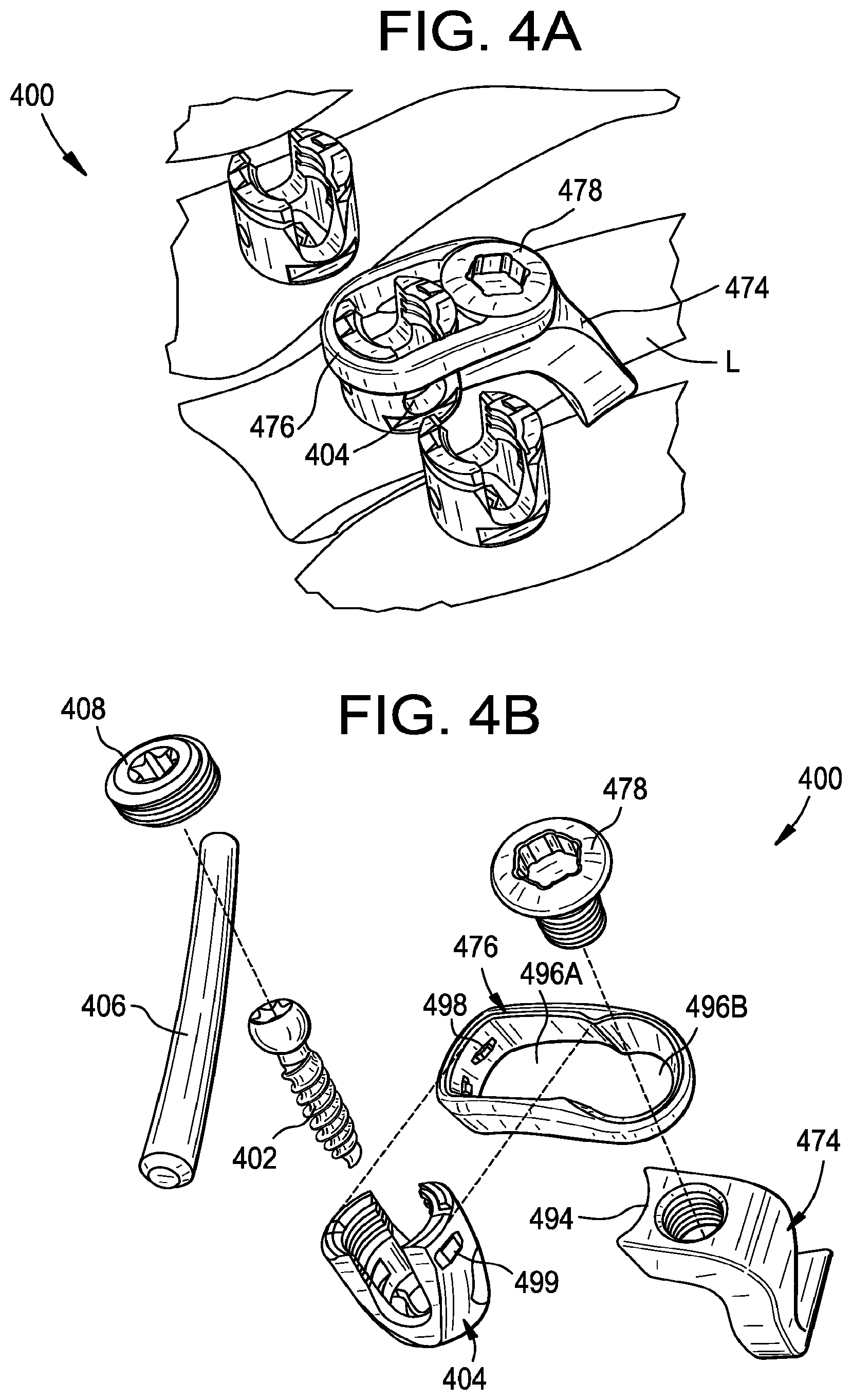 Patent US11793551 Figure 11 – Multipoint fixation implants