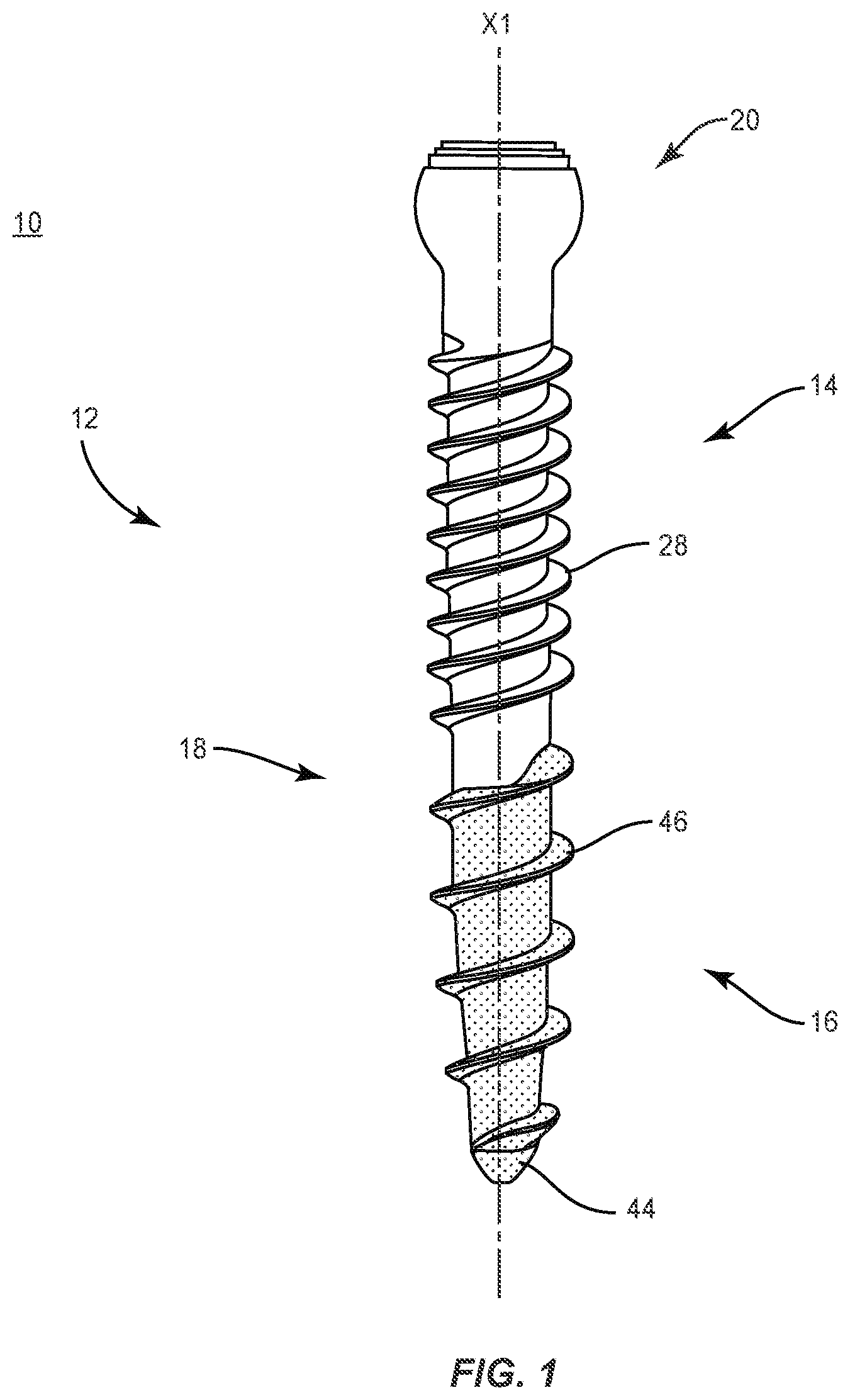 Patent US11793557 — System and method of manufacture for spinal implant — Figure 1