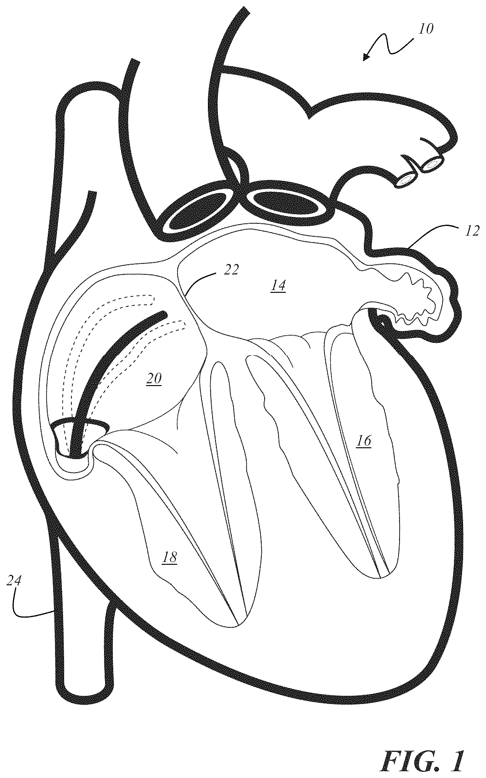 Patent US11793572 — Selecting a medical device for use in a medical procedure — Figure 1