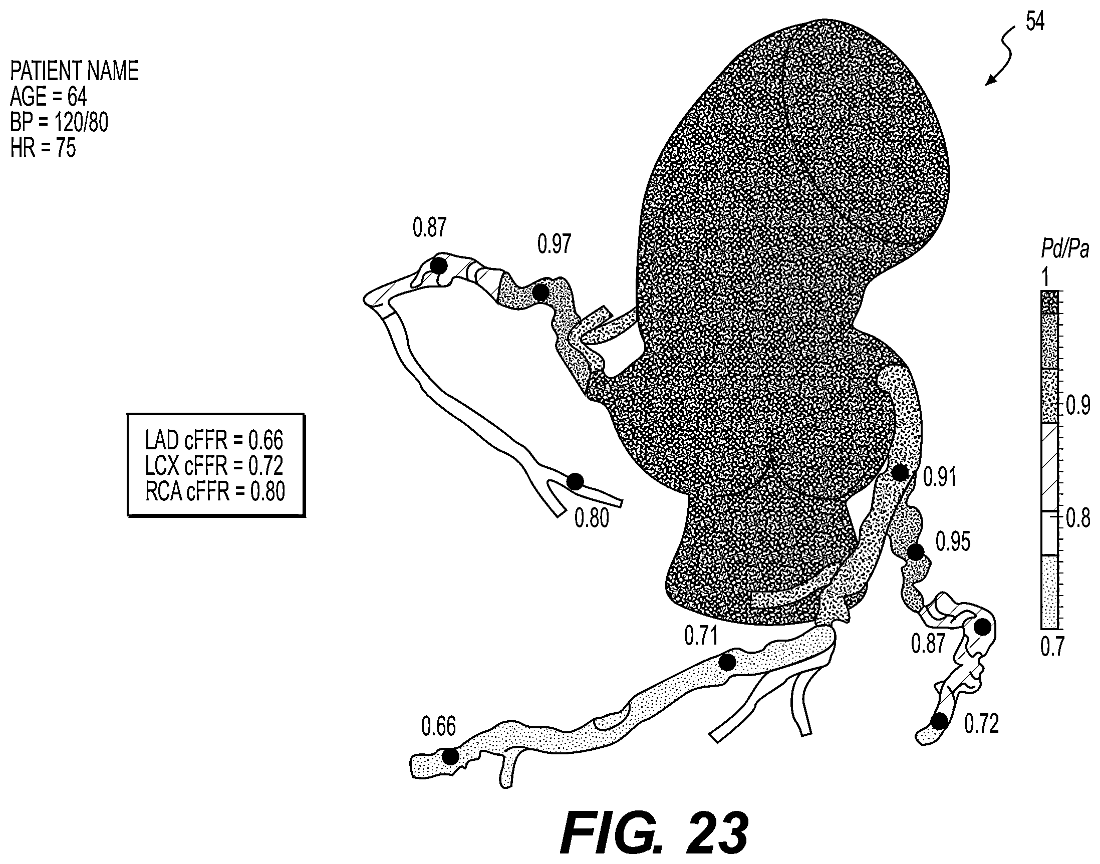 Patent US11793575 Figure 12 – Method and system for image processing to determine blood flow