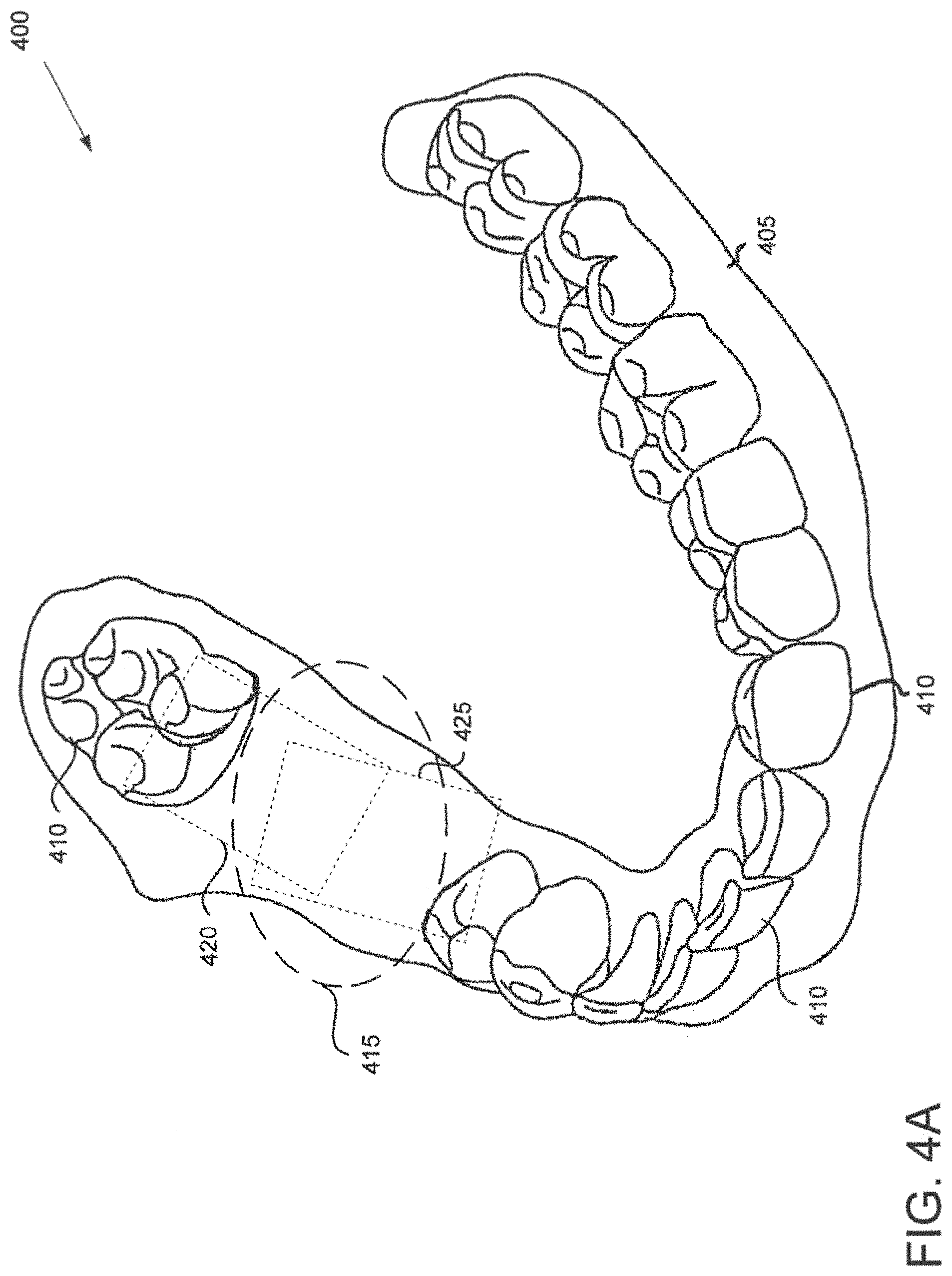 Patent US11793610 Figure 4 – Image registration of intraoral images using non-rigid indicia