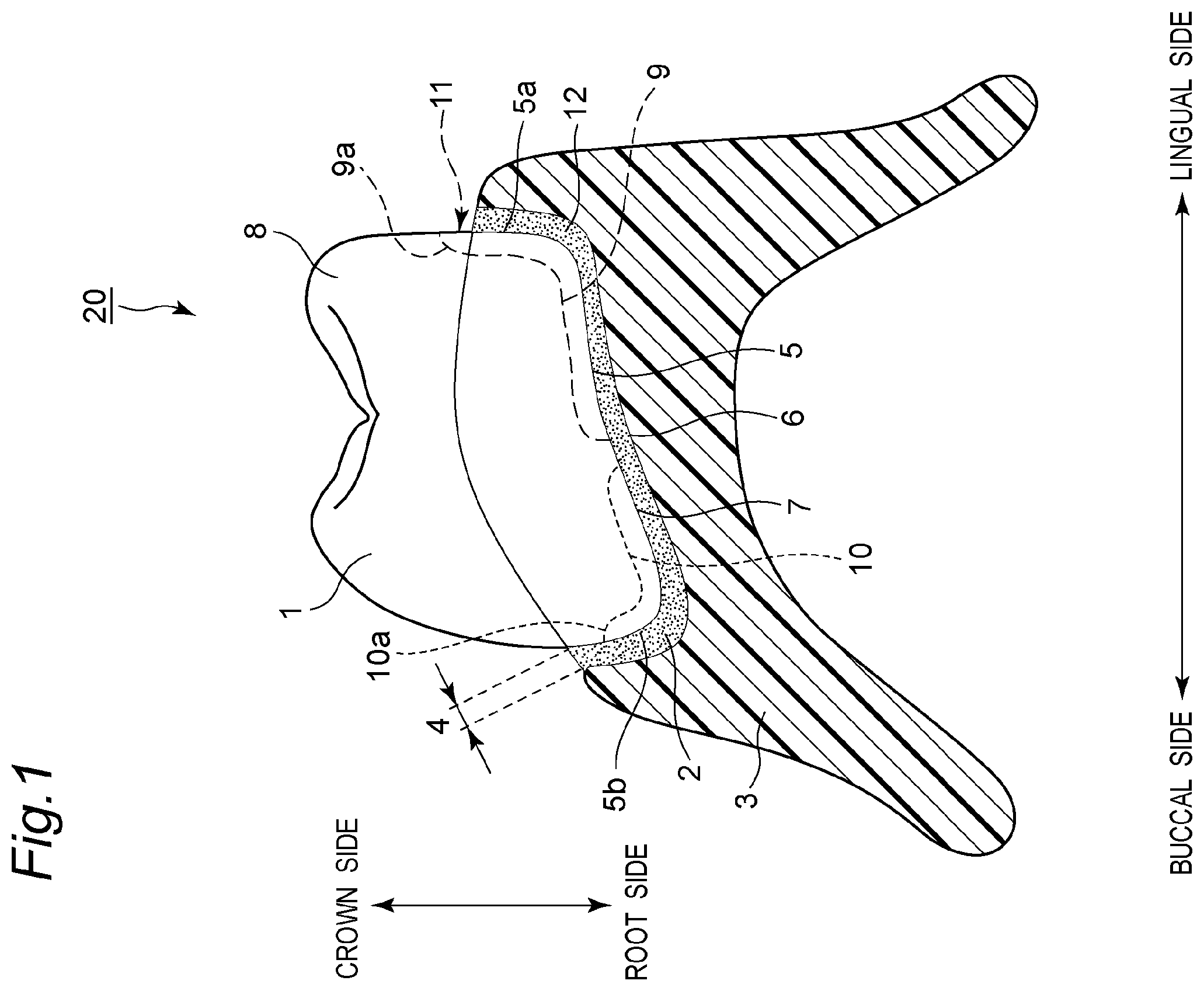 Patent US11793614 — Method for producing denture with high accuracy of fitting of artificial tooth to socket — Figure 1