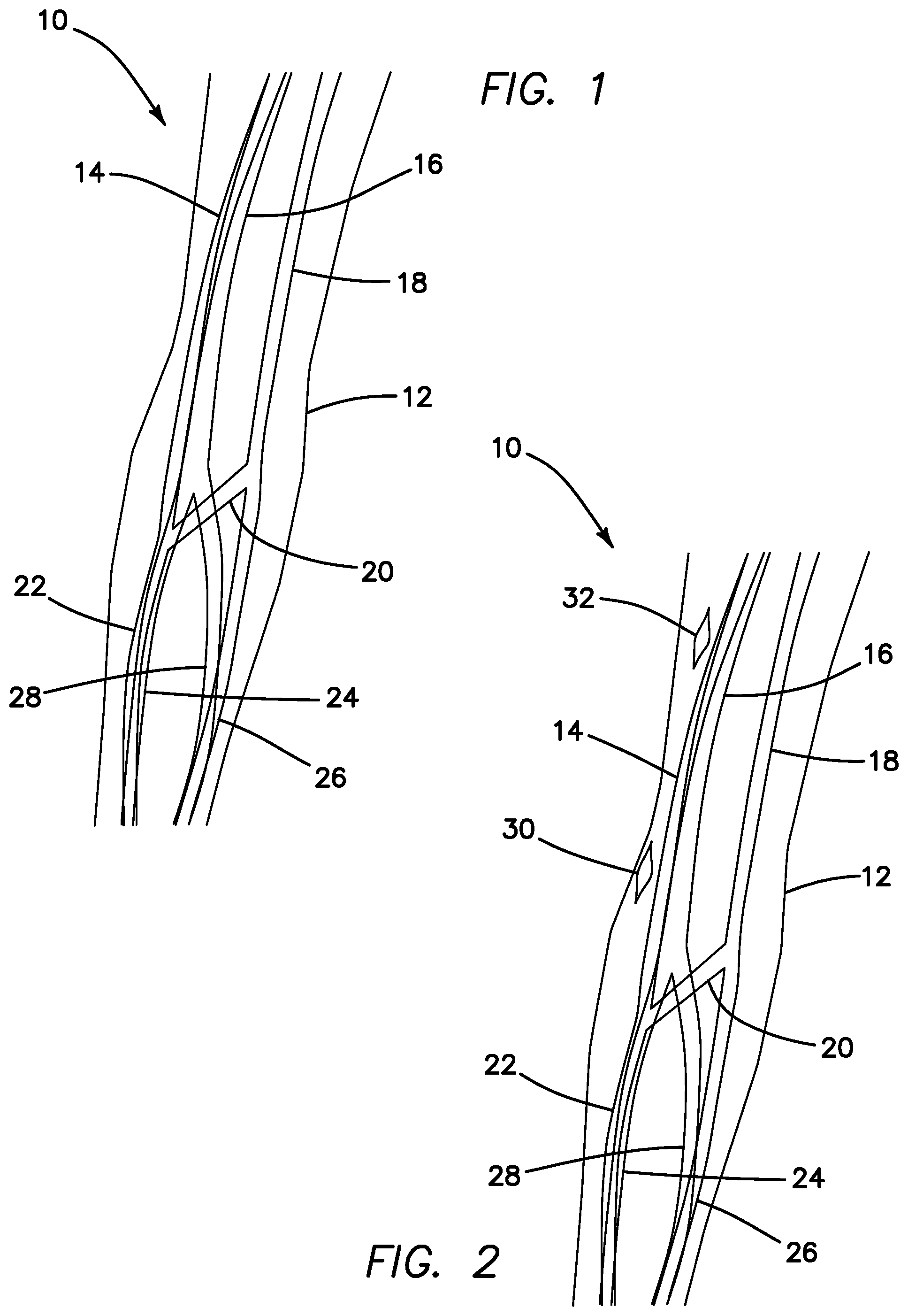 Patent US11793623 Figure 1 – Systems and methods for percutaneously placing biologic grafts at a procedural site