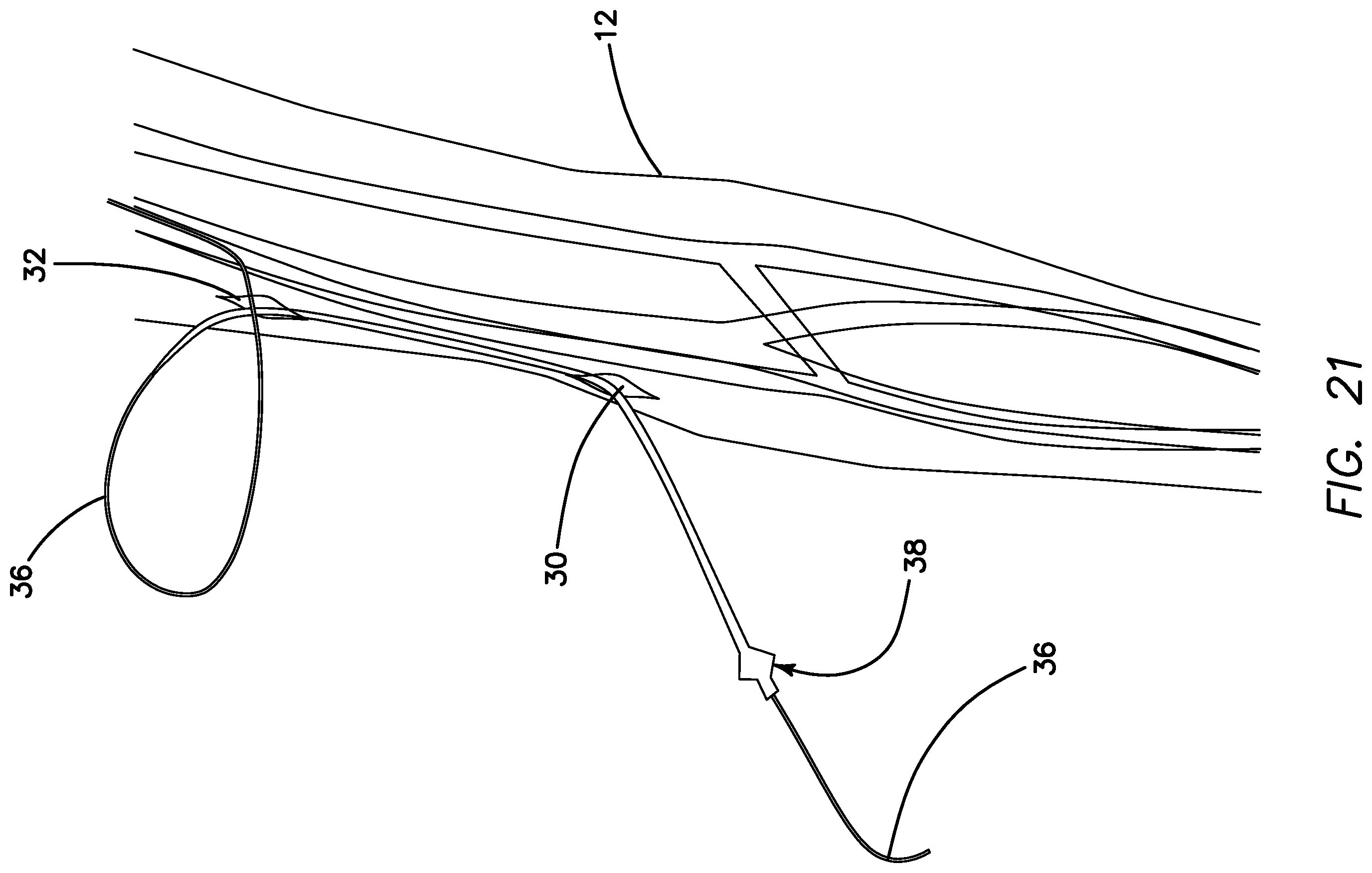 Patent US11793623 Figure 18 – Systems and methods for percutaneously placing biologic grafts at a procedural site