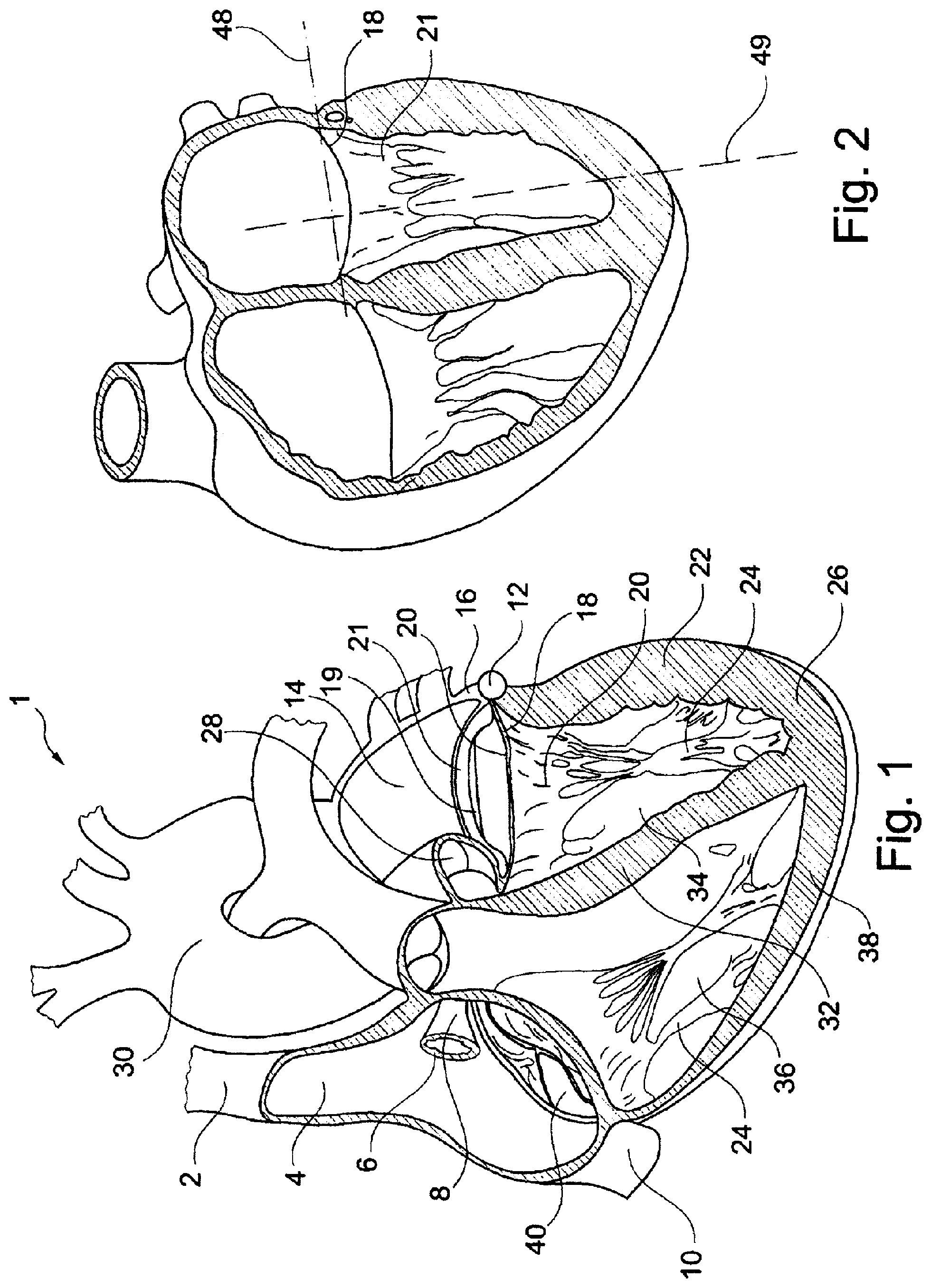 Patent US11793629 — Device and a method for augmenting heart function — Figure 1