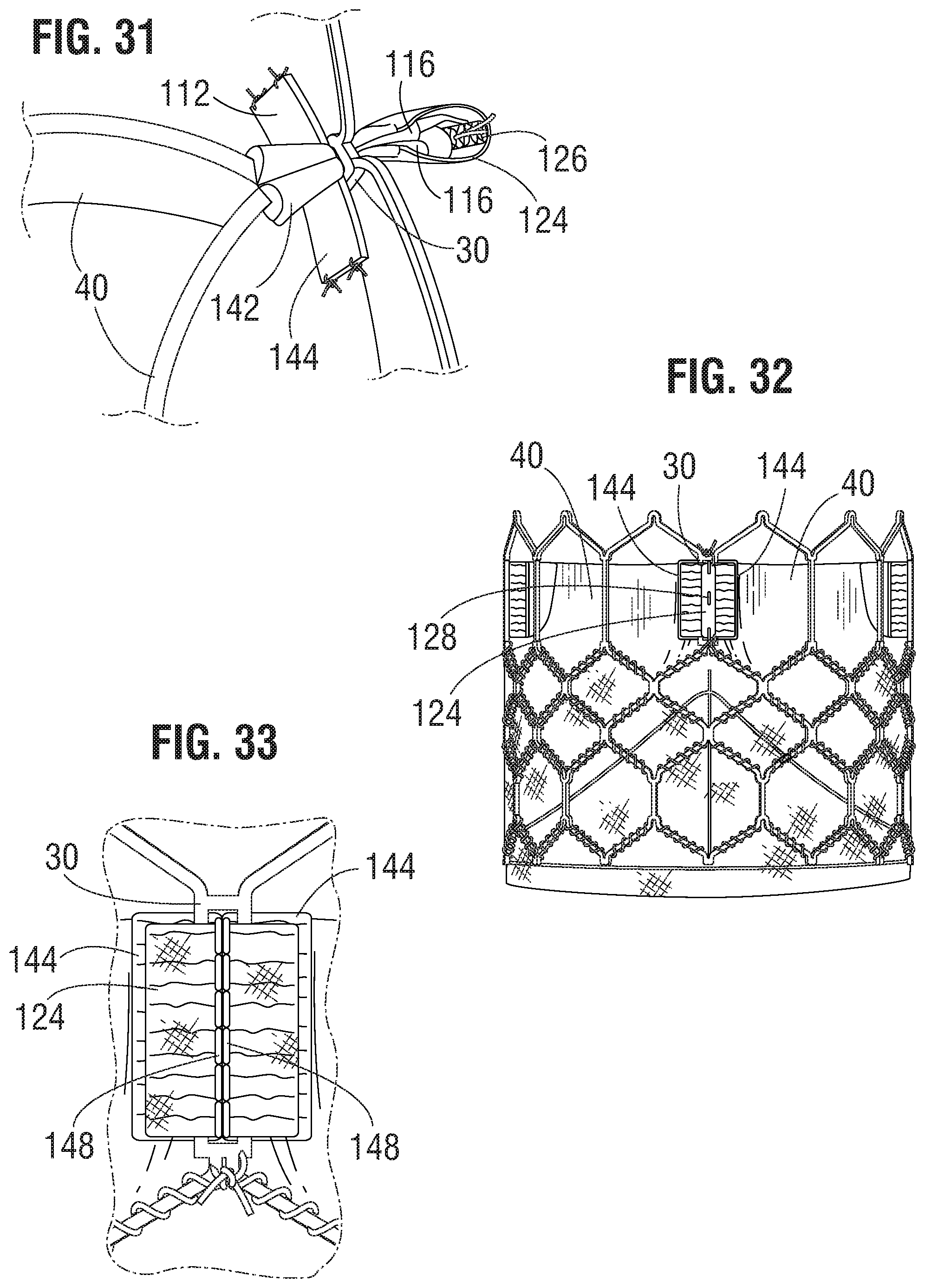 Patent US11793632 Figure 11 – Prosthetic heart valve