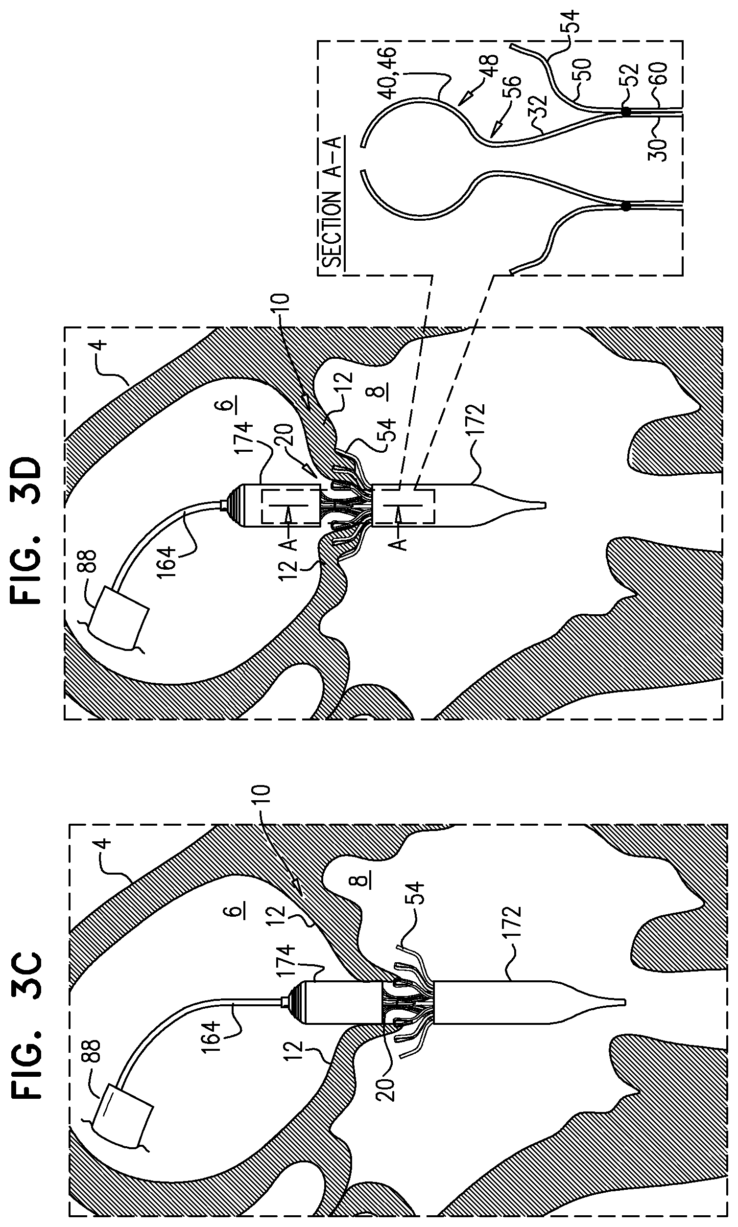 Patent US11793633 Figure 6 – Prosthetic heart valve