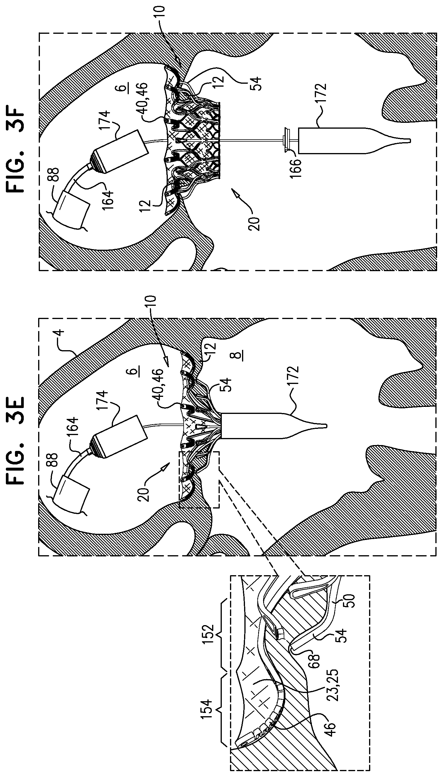 Patent US11793633 Figure 7 – Prosthetic heart valve