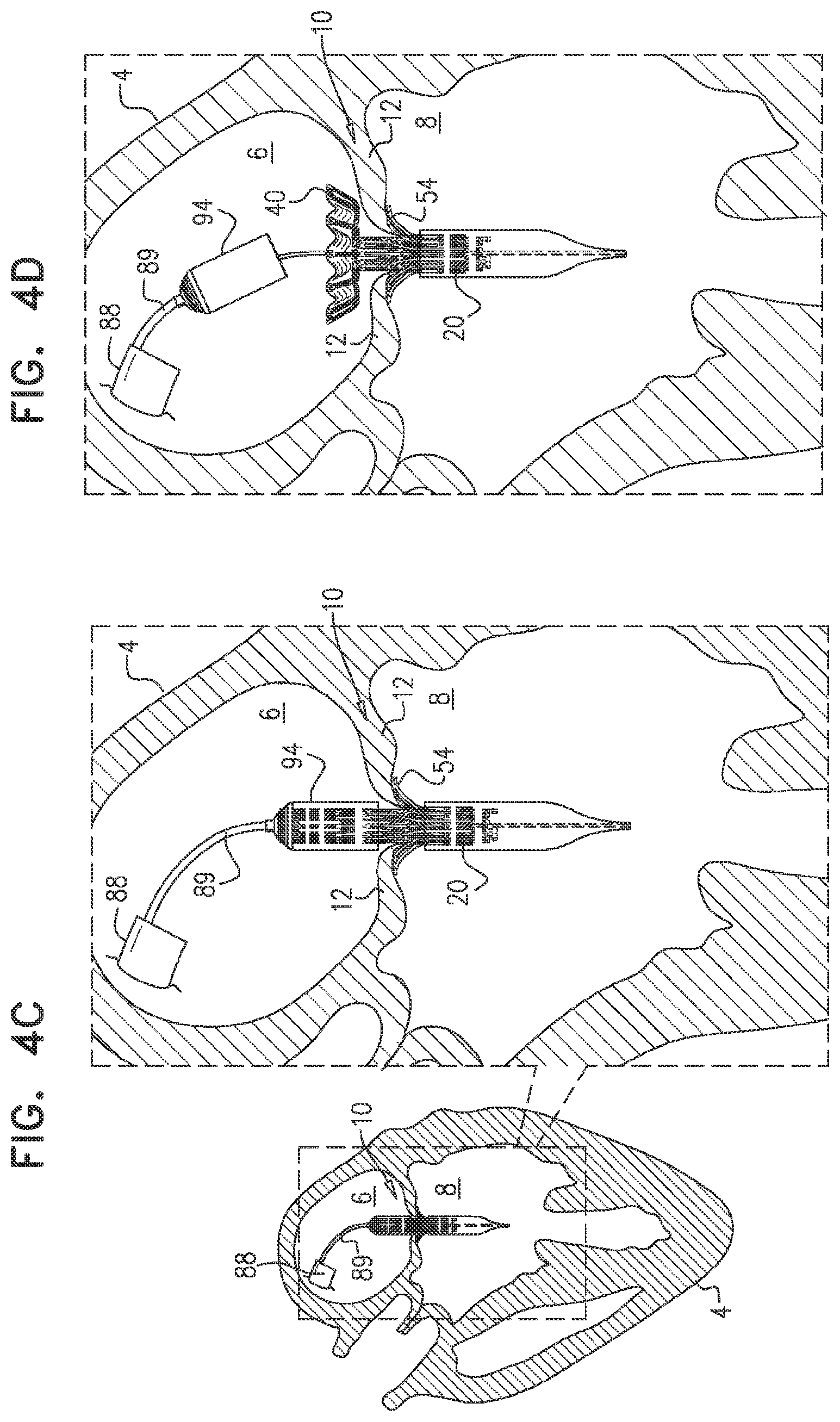 Patent US11793635 Figure 8 – Prosthetic valve with angularly offset frames