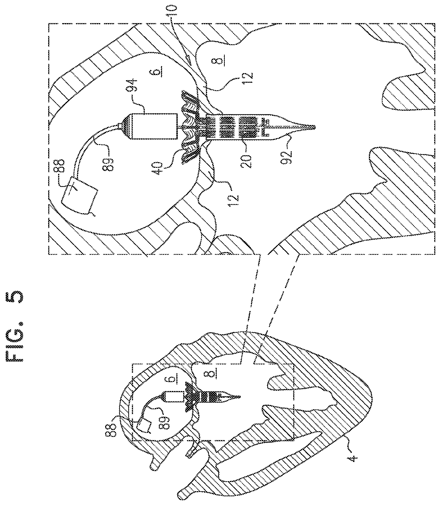 Patent US11793635 Figure 10 – Prosthetic valve with angularly offset frames