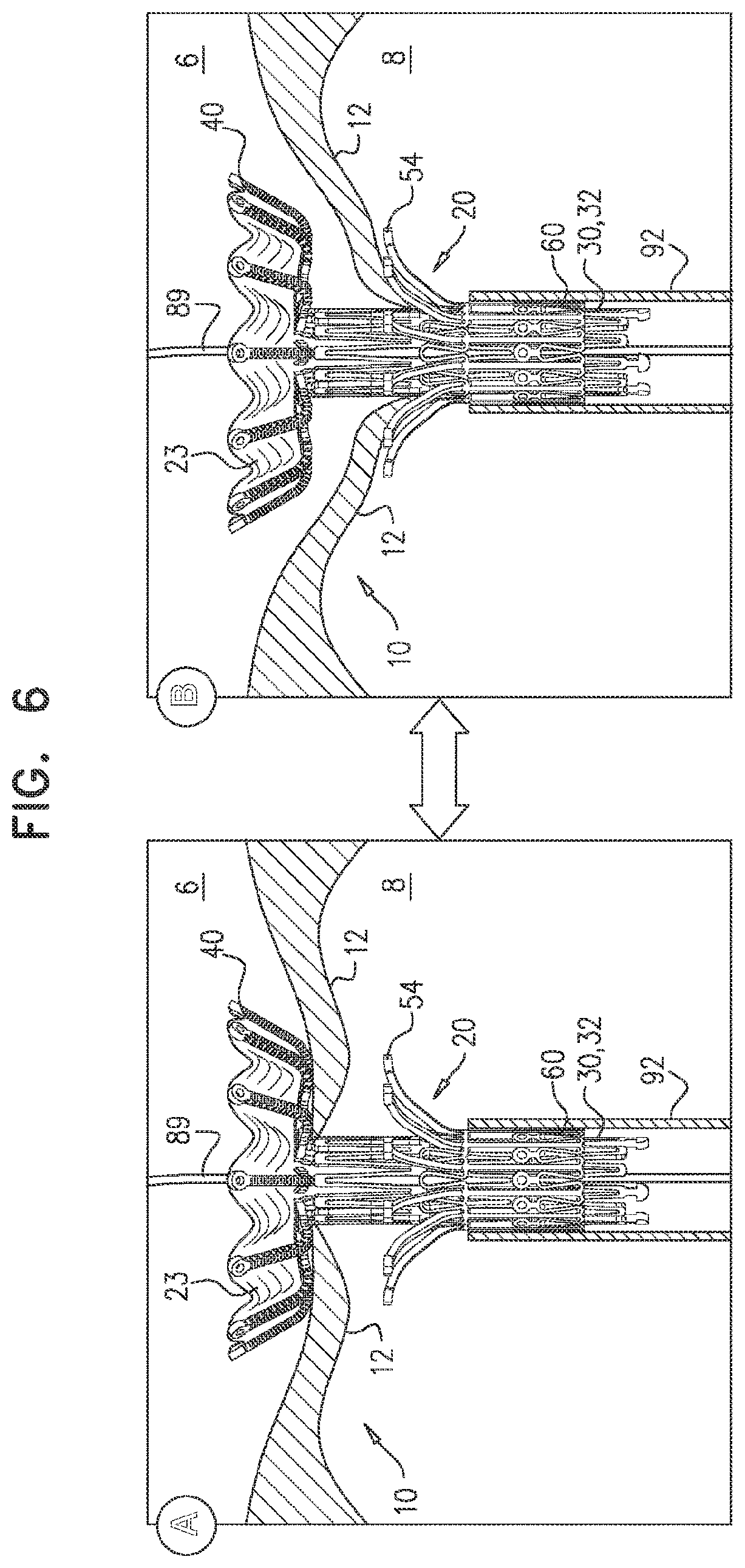 Patent US11793635 Figure 11 – Prosthetic valve with angularly offset frames