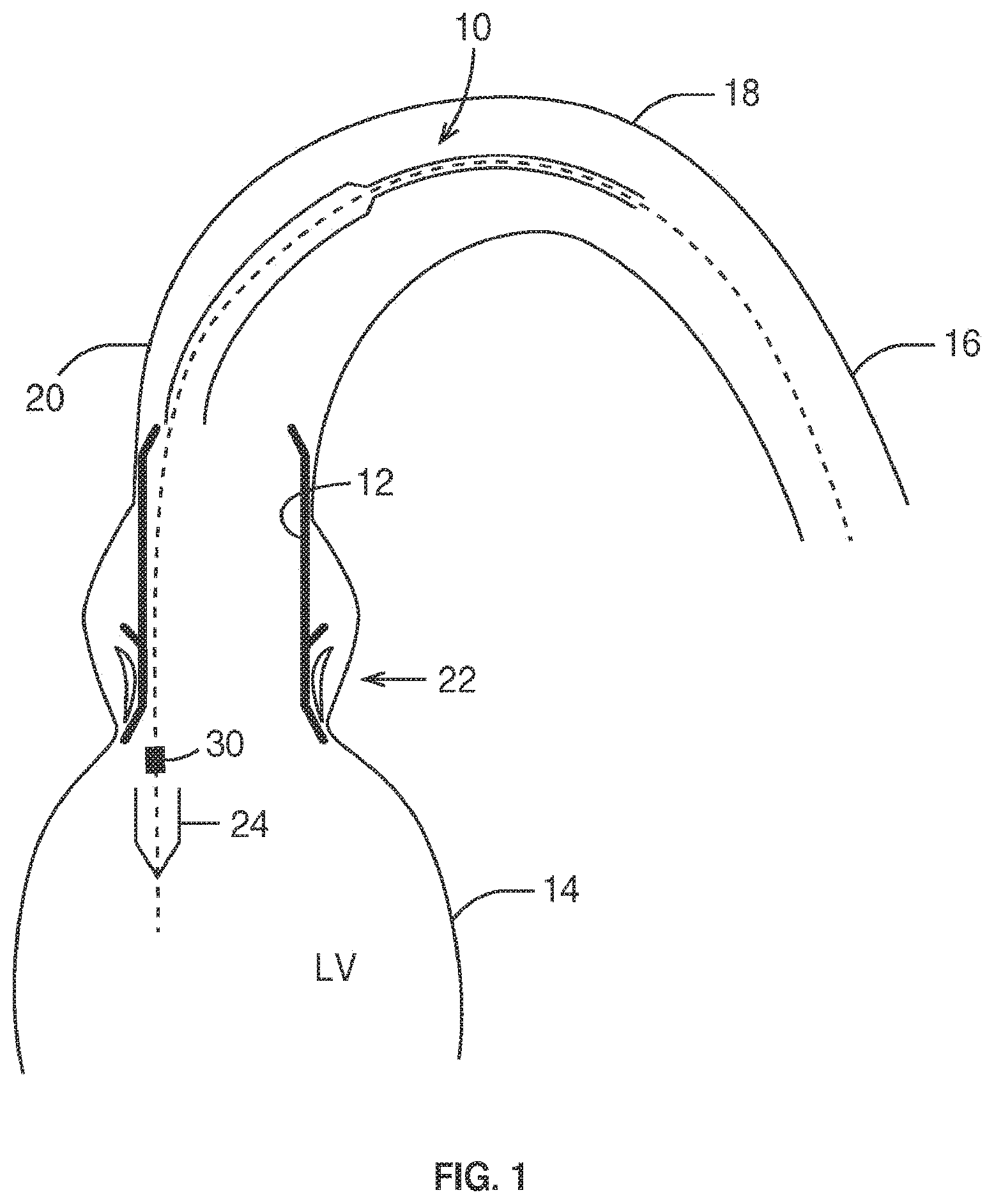 Patent US11793636 Figure 1 – Prosthetic valve. delivery apparatus and delivery method