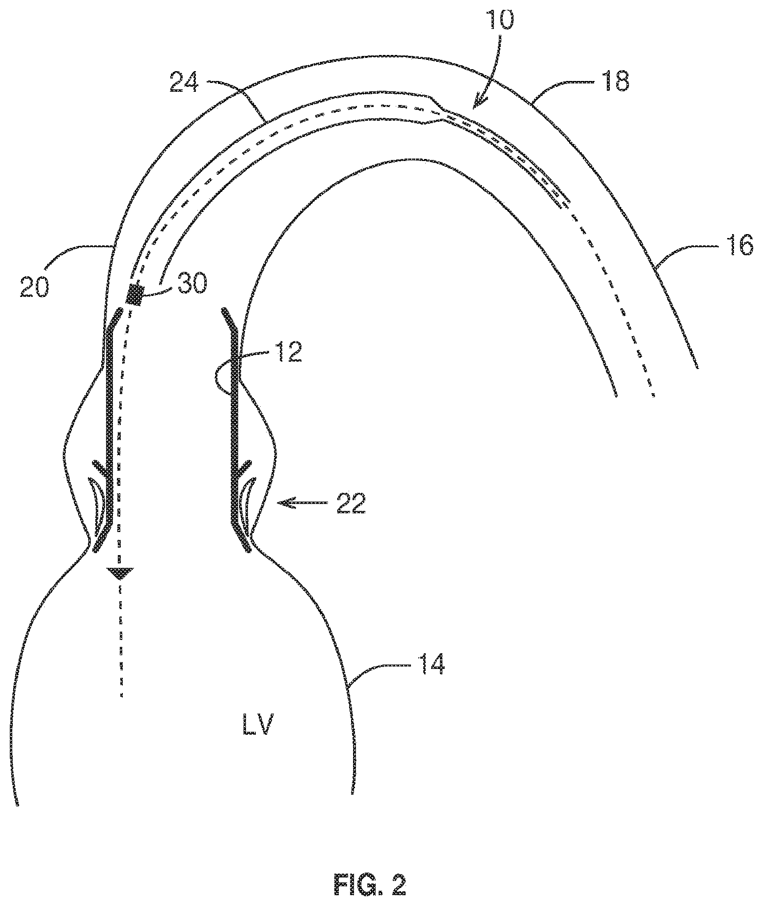 Patent US11793636 Figure 2 – Prosthetic valve. delivery apparatus and delivery method