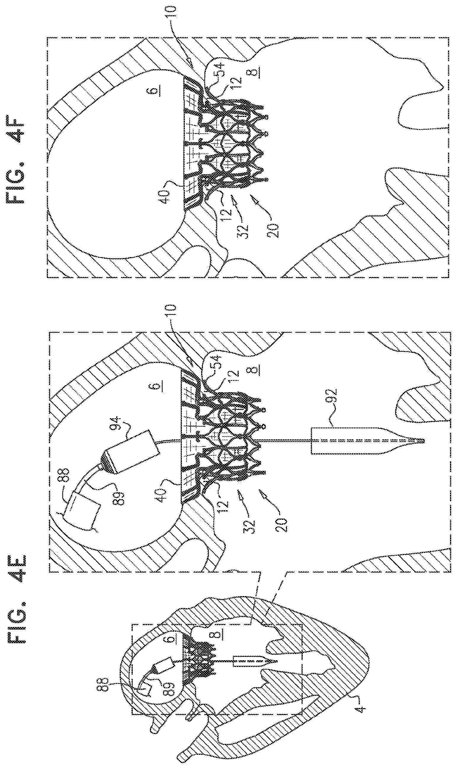 Patent US11793638 Figure 9 – Prosthetic valve with pivoting tissue anchor portions