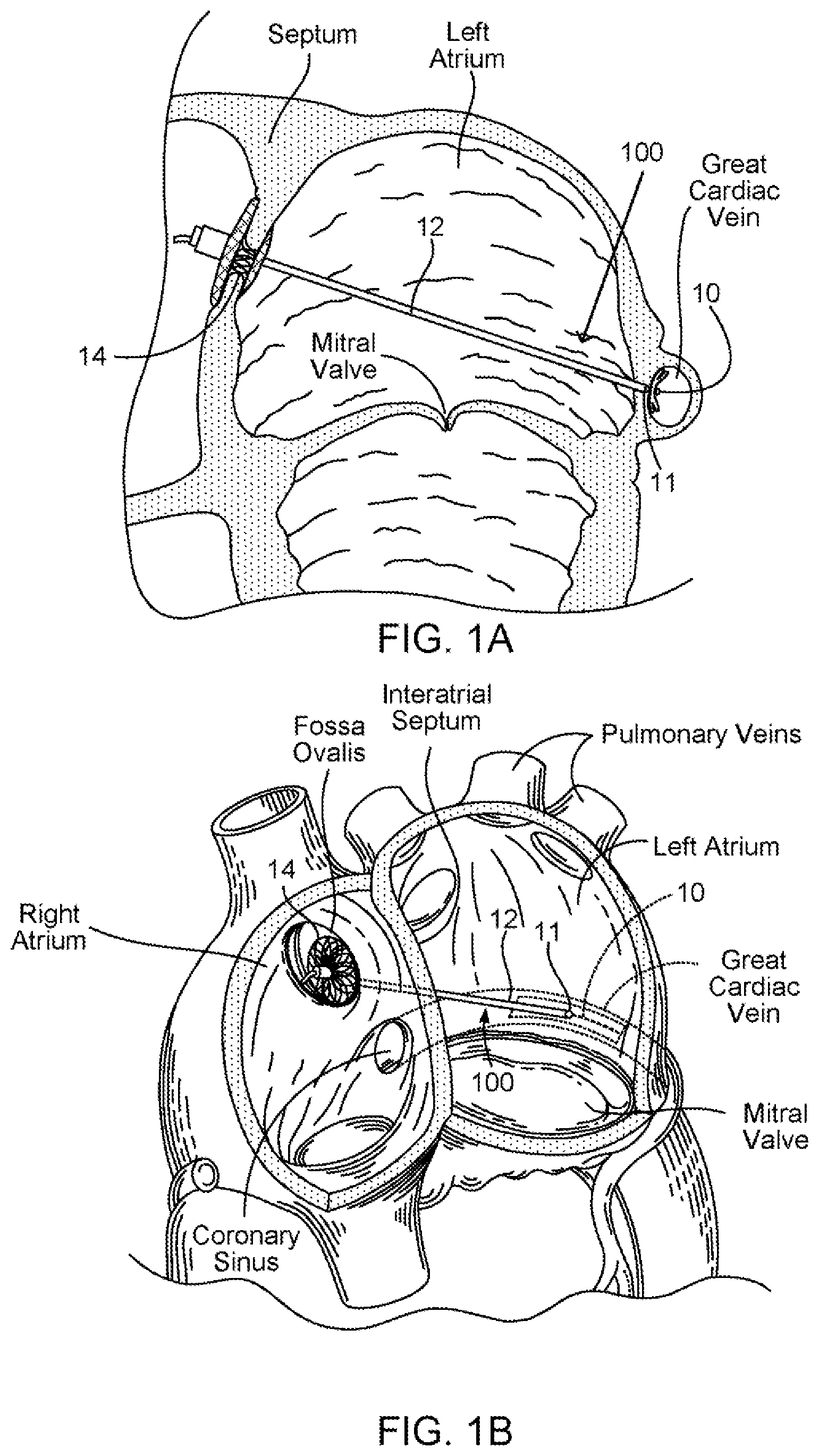 Patent US11793639 — Devices, systems and methods for reshaping a heart valve annulus — Figure 1