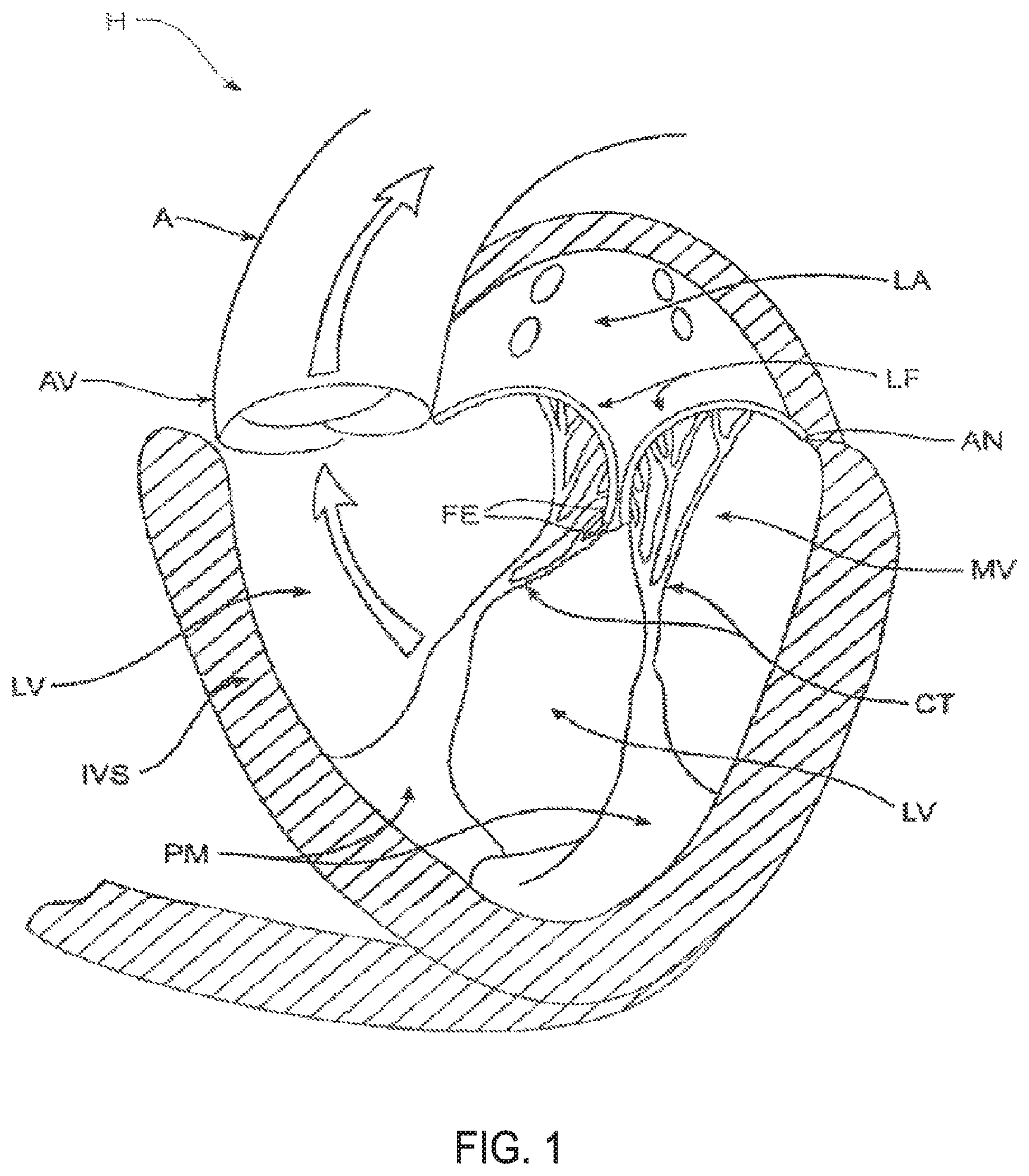 Patent US11793640 — Sequentially deployed transcatheter mitral valve prosthesis — Figure 1
