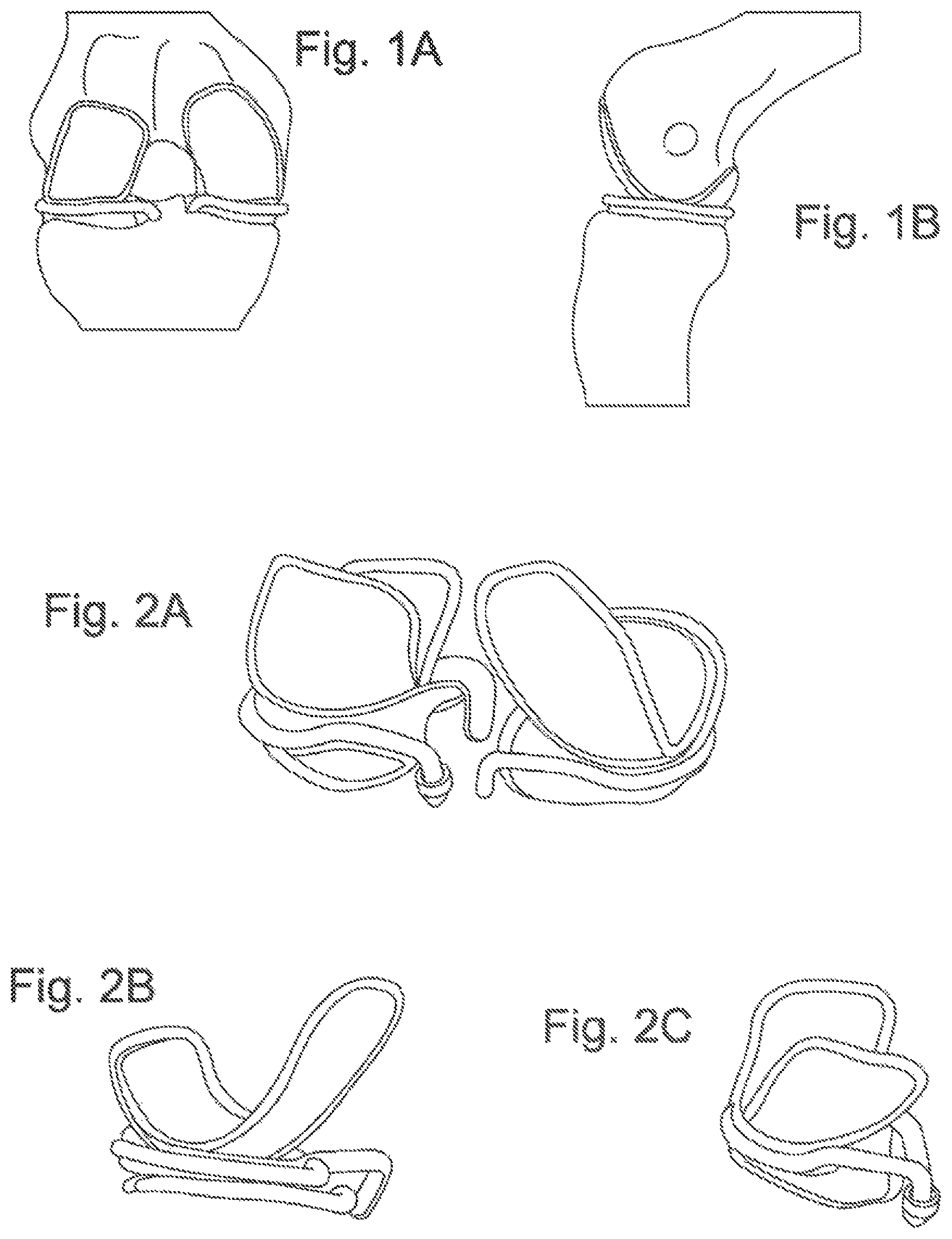 Patent US11793646 Figure 1 – Rigid segmented flexible anchors