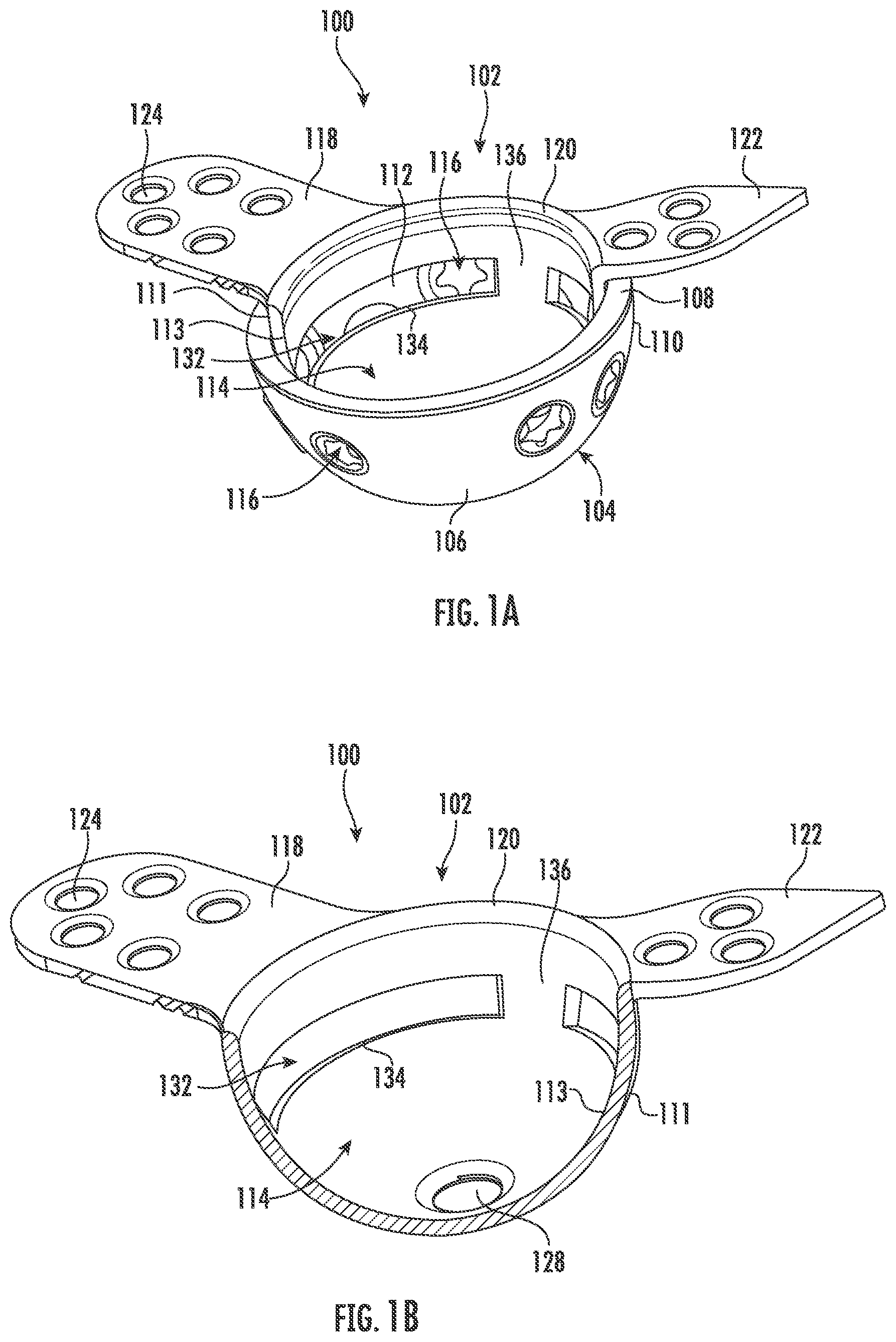 Patent US11793647 — Acetabular apparatuses for hip revision surgery — Figure 1