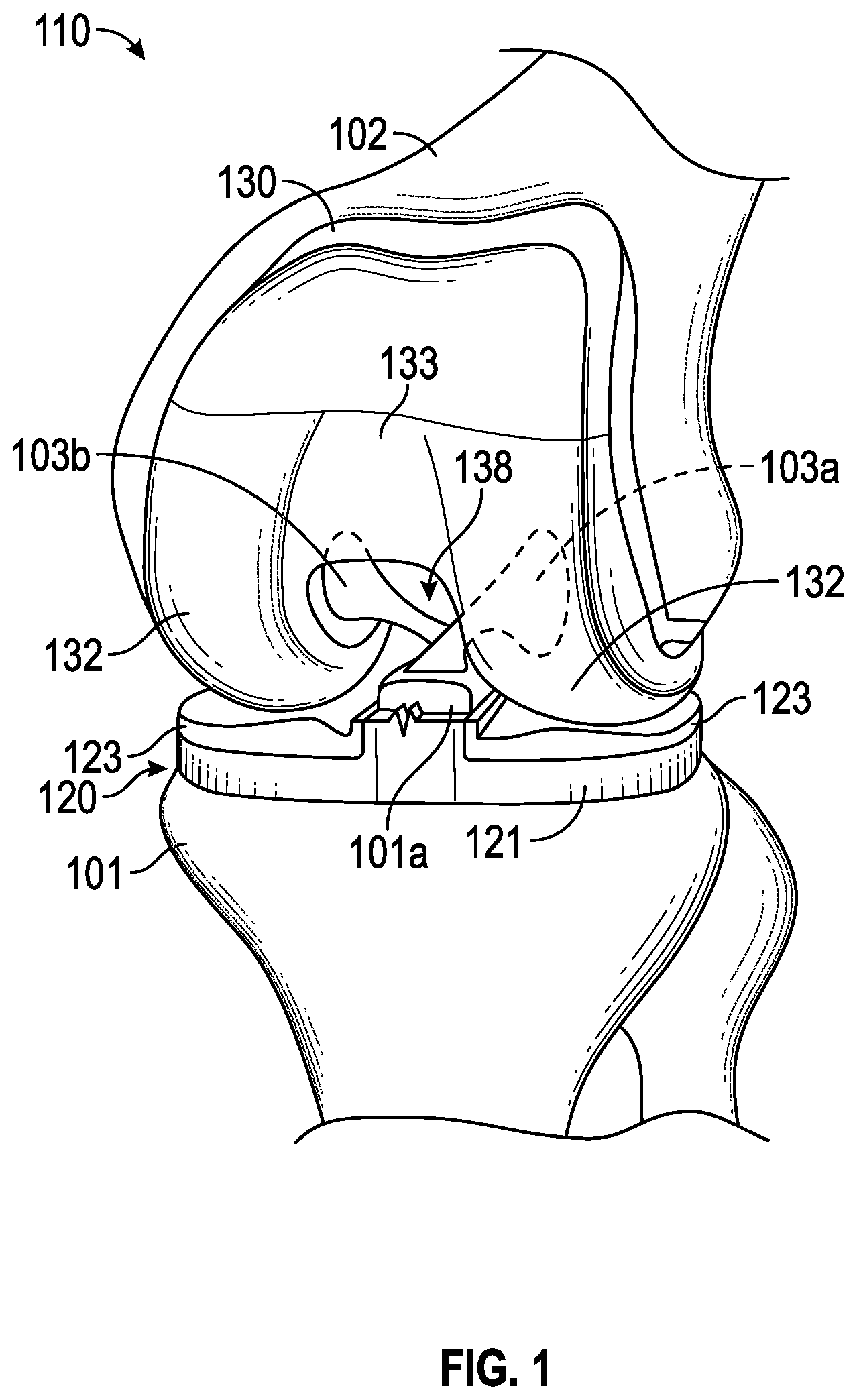 Patent US11793649 Figure 1 – Femoral component for bone conservation