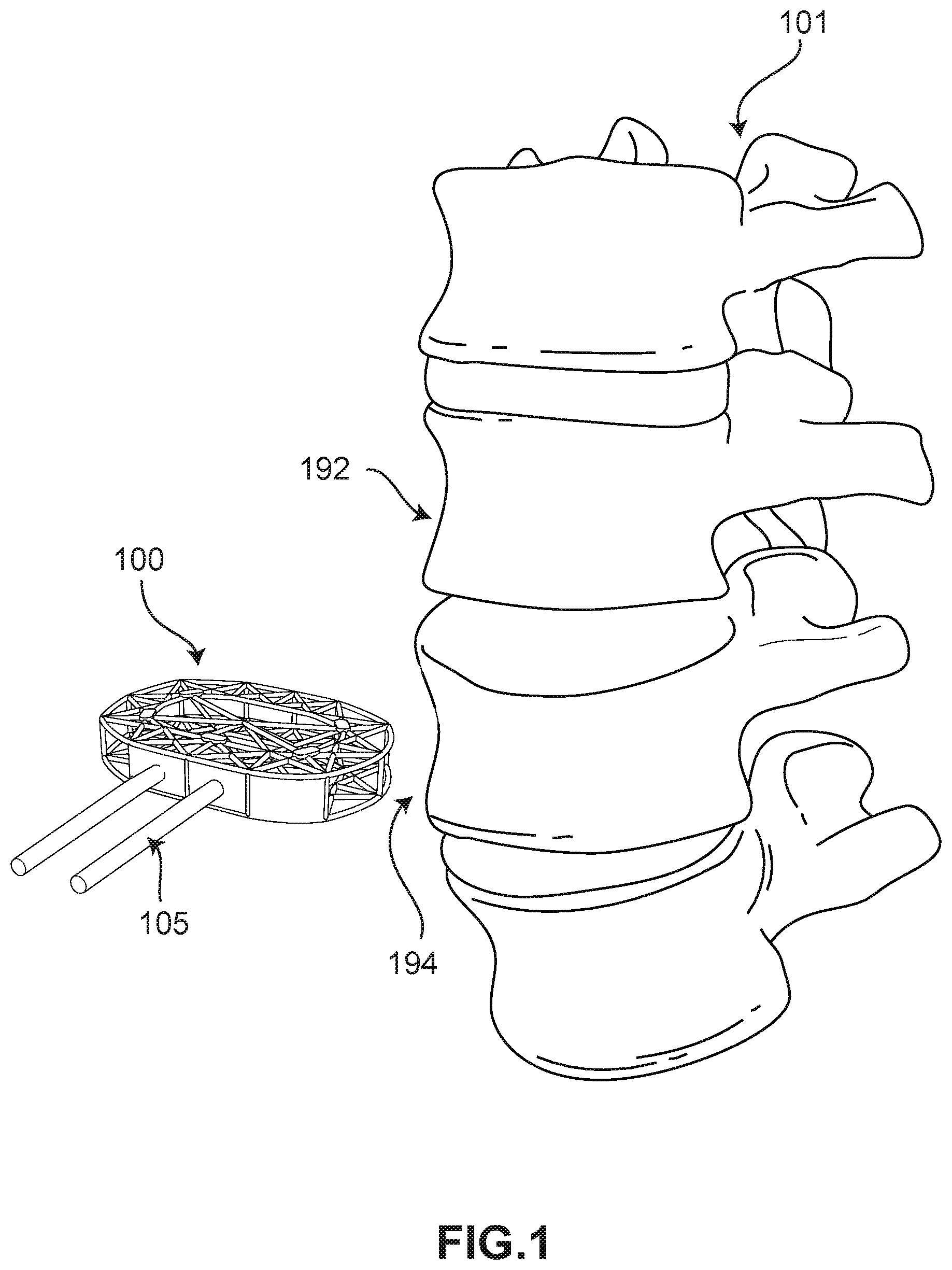 Patent US11793652 — Implant with improved bone contact — Figure 1