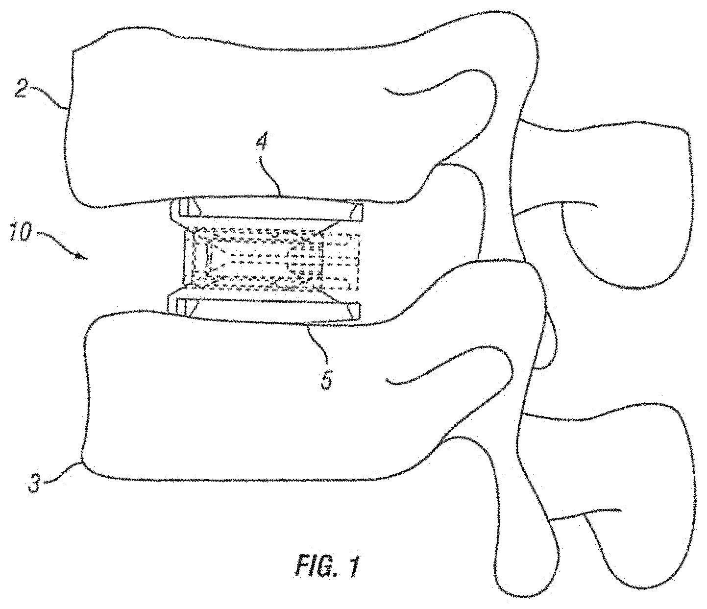 Patent US11793654 — Expandable fusion device and method of installation thereof — Figure 1