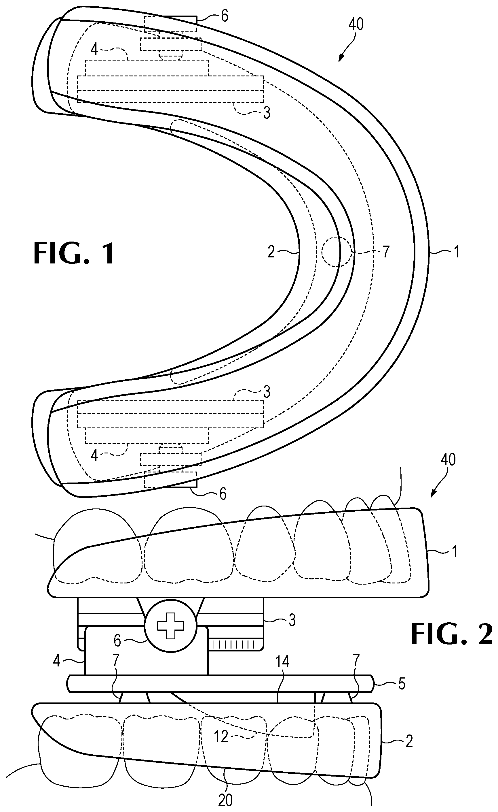 Patent US11793666 Figure 1 – Intra-oral snore and sleep apnea treatment appliance