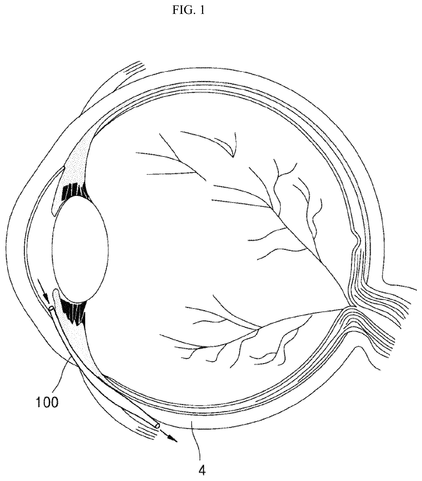 Patent US11793673 — Implant device for eye disease for adjusting intraocular pressure — Figure 1