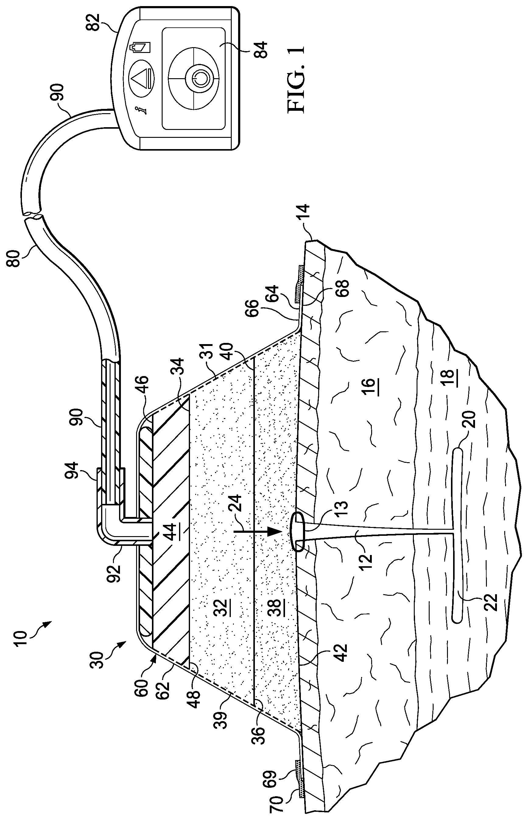 Patent US11793679 Figure 1 – Super-absorbent, reduced-pressure wound dressing and systems
