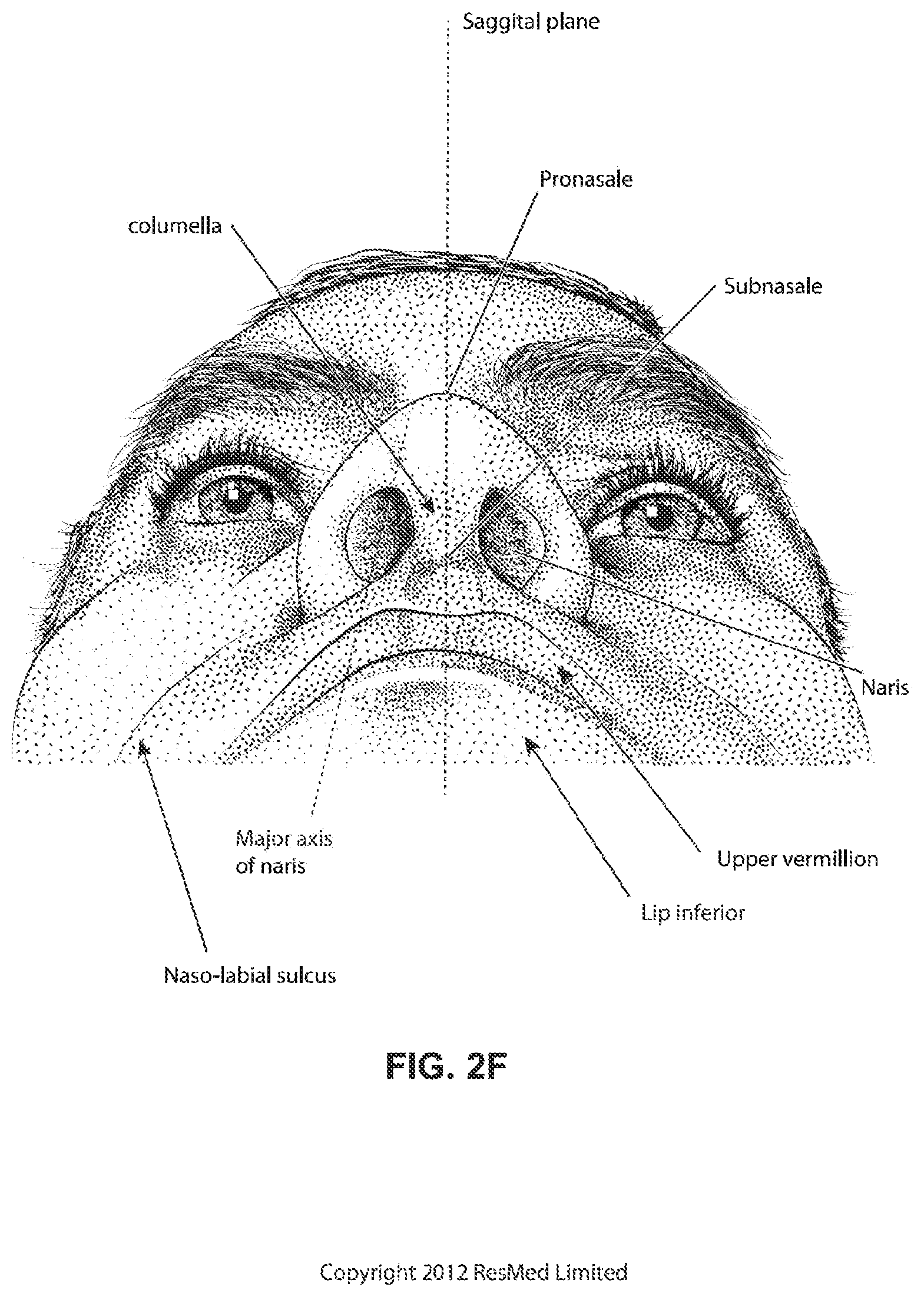 Patent US11793965 Figure 9 – Adjustable headgear tubing for a patient interface