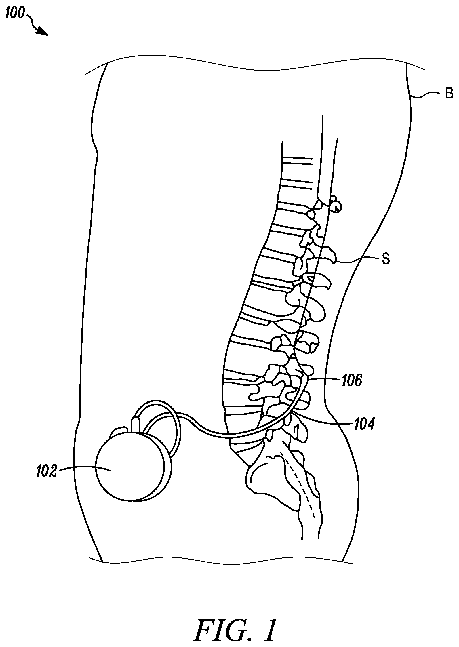 Patent US11793971 — Curved catheter for increased intrathecal drug dispersion — Figure 1