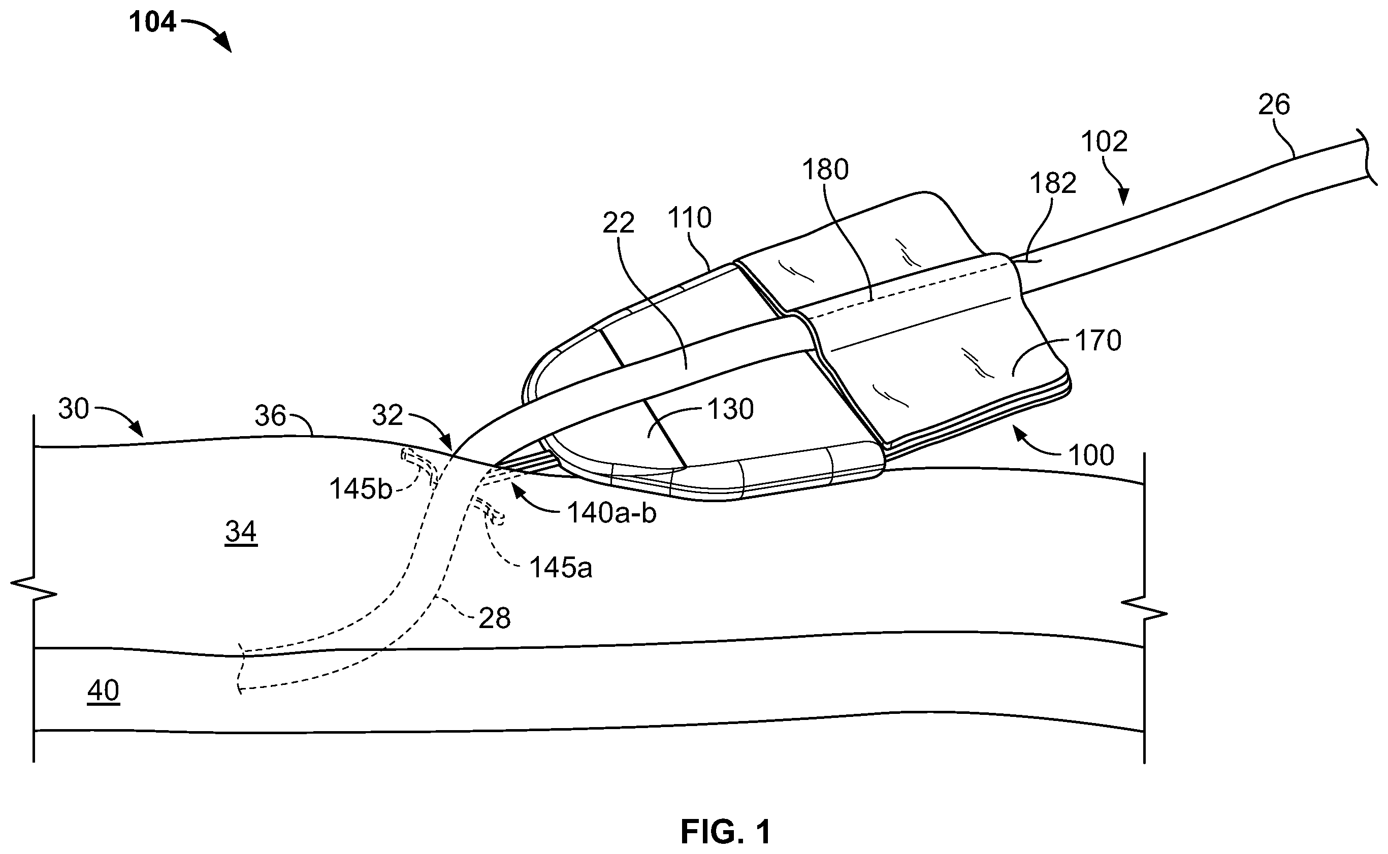 Patent US11793975 — Systems and methods for anchoring medical devices — Figure 1