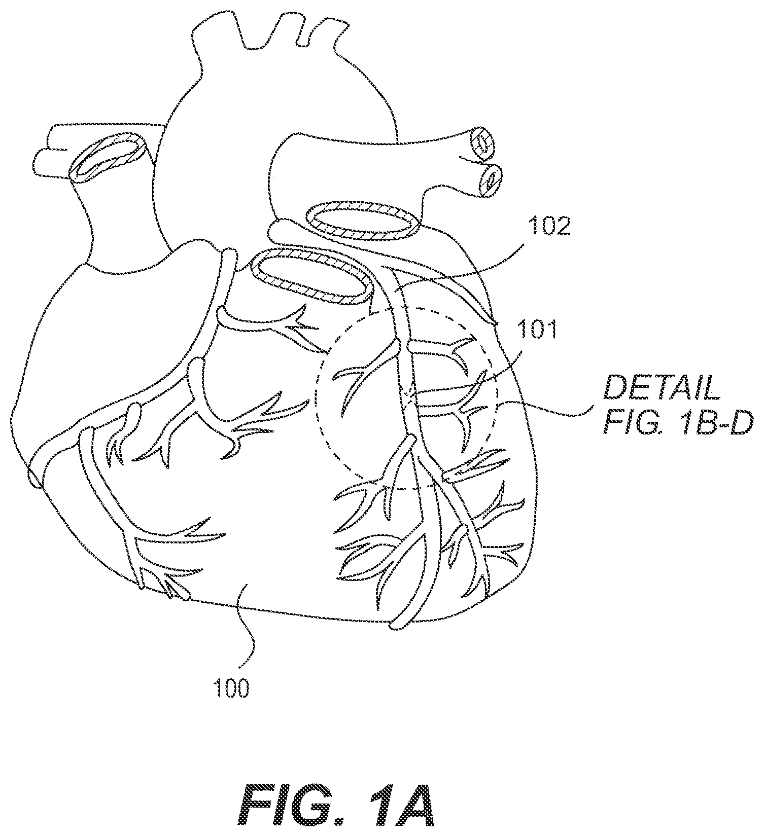 Patent US11793978 — Endovascular devices and methods — Figure 1
