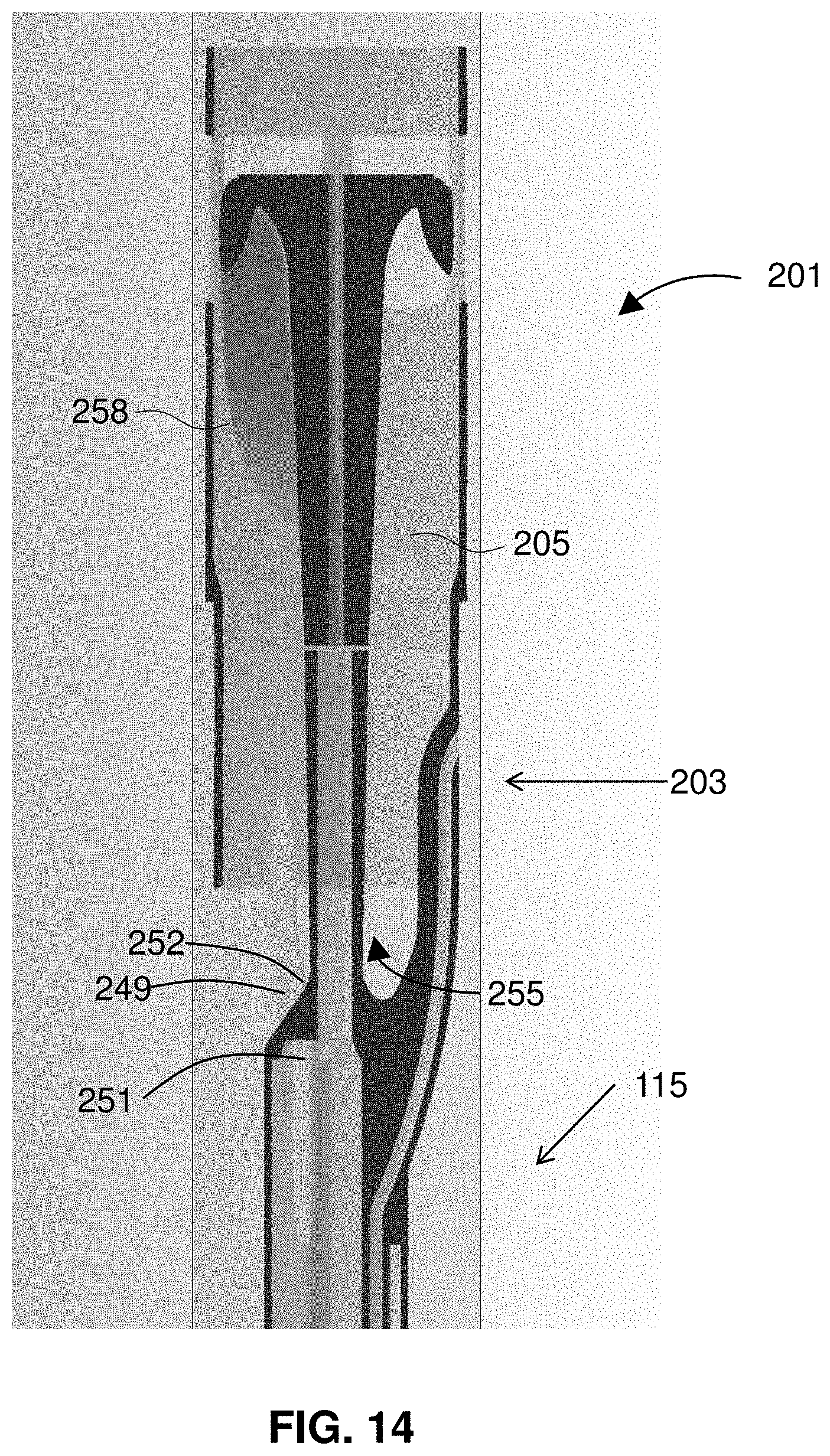 Patent US11793996 Figure 14 – Devices and methods for treating edema