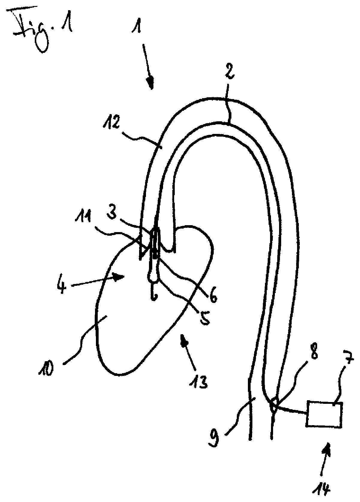 Patent US11793997 Figure 1 – Pump, in particular a blood pump