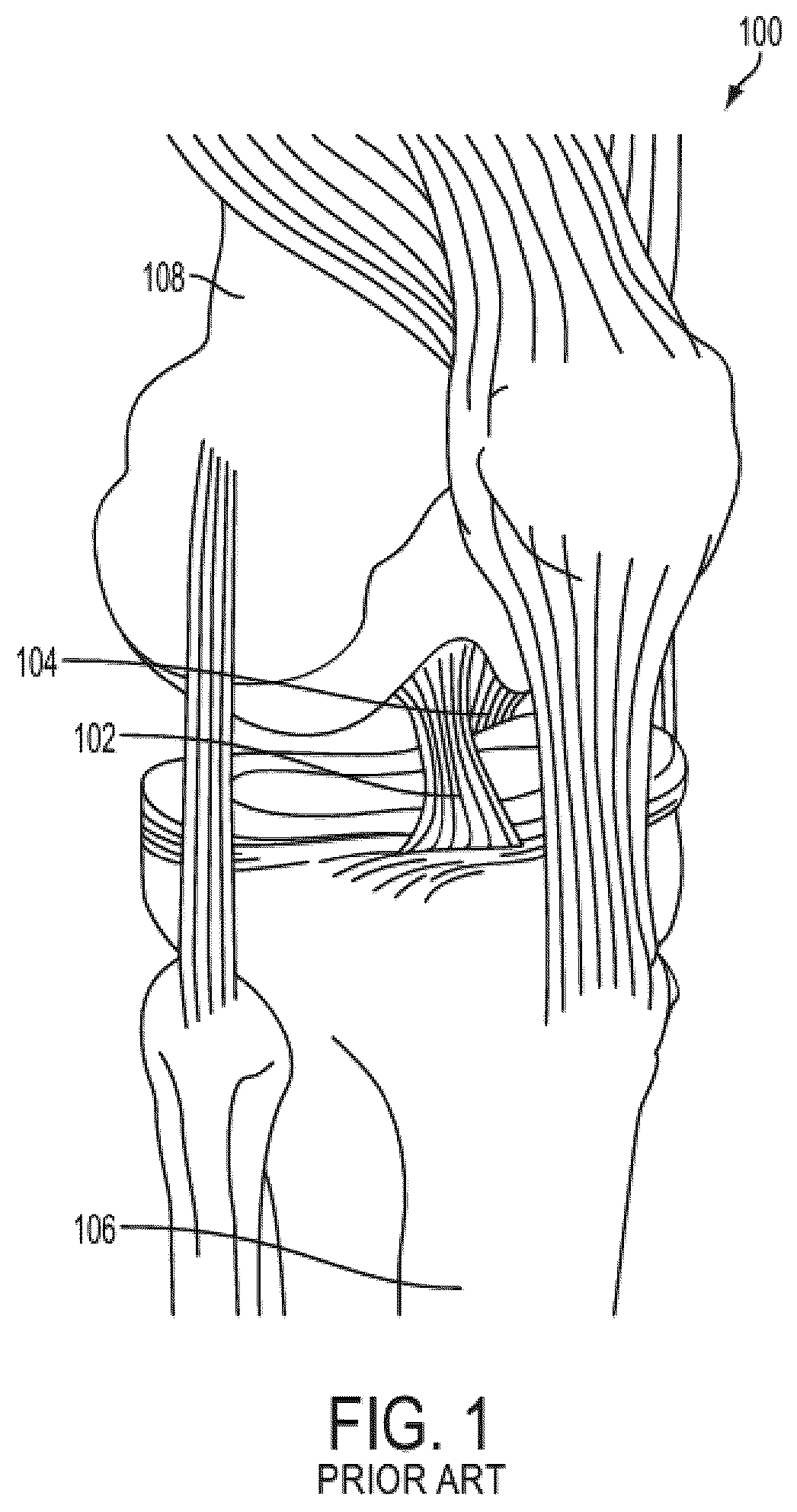Patent US11812945 — One-way adjustable loop suture constructs and methods of forming and using the same — Figure 1