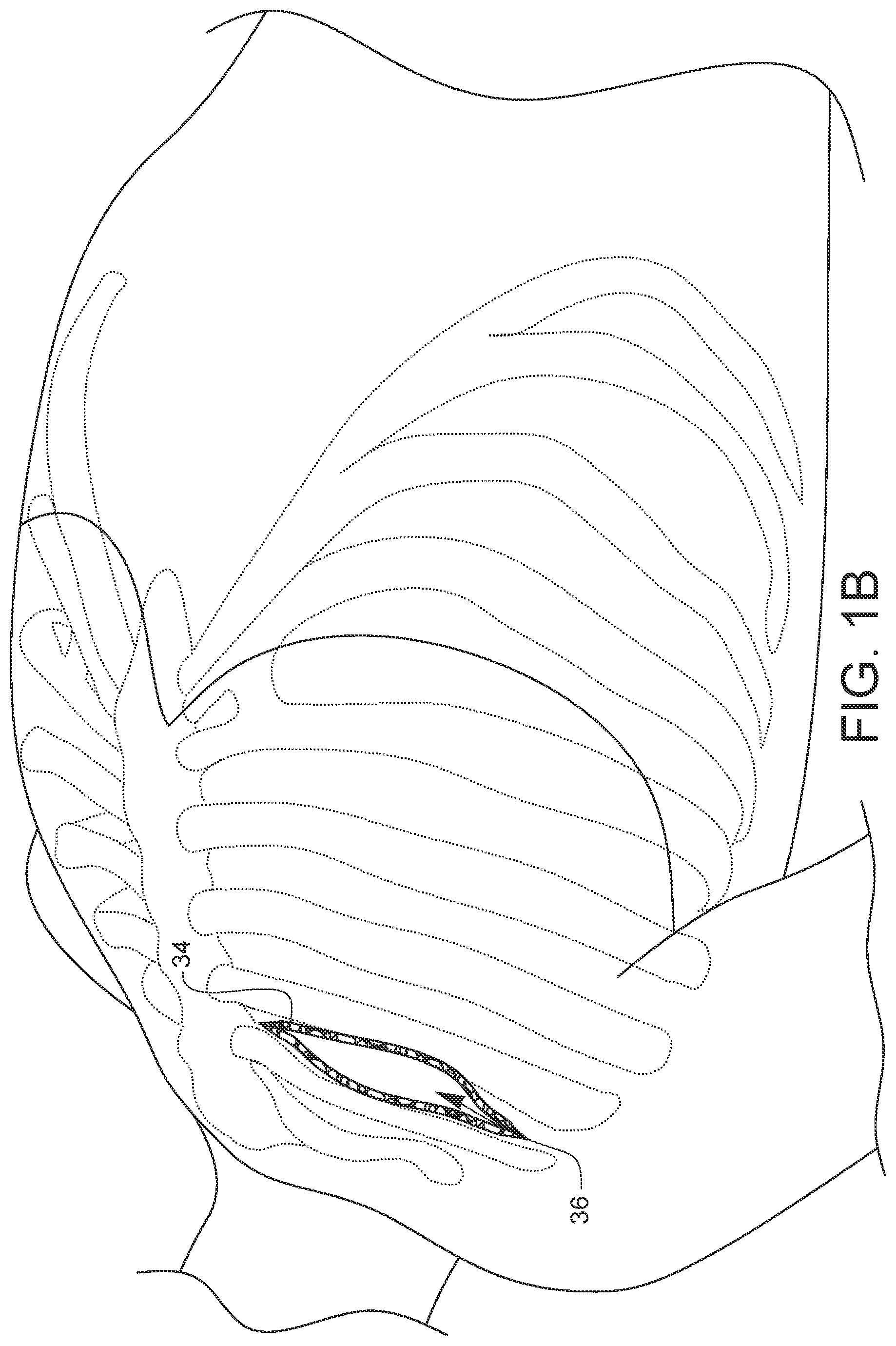Patent US11812947 Figure 2 – Apparatus for suture management and methods thereof